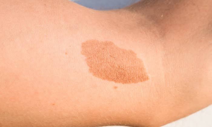 ปานสีกาแฟใส่นม (Café au lait) มีลักษณะอย่างไร? & ดูแลได้อย่างไร ? ปานสีกาแฟใส่นม (Café au lait) มีลักษณะอย่างไร? & ดูแลได้อย่างไร ?