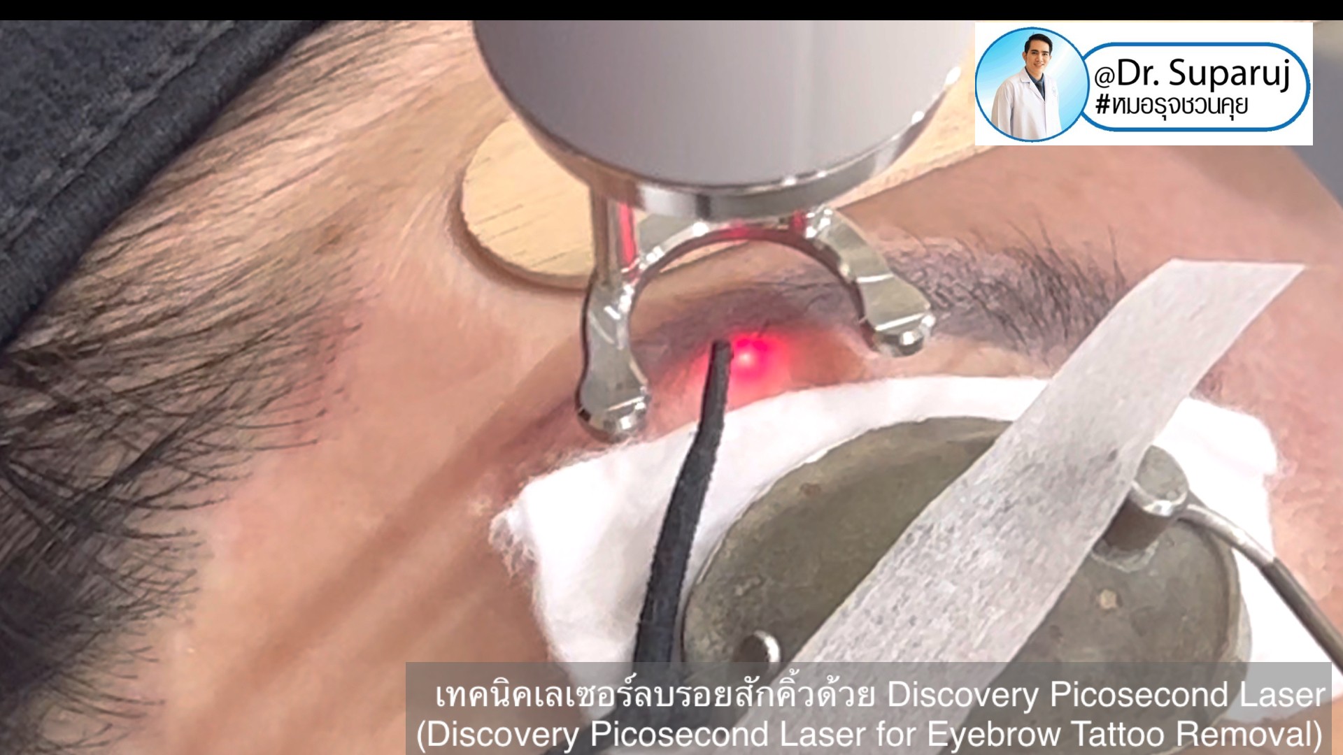 เทคนิคเลเซอร์ลบรอยสักคิ้วด้วย Discovery Picosecond Laser (Discovery Picosecond Laser for Eyebrow Tattoo Removal)