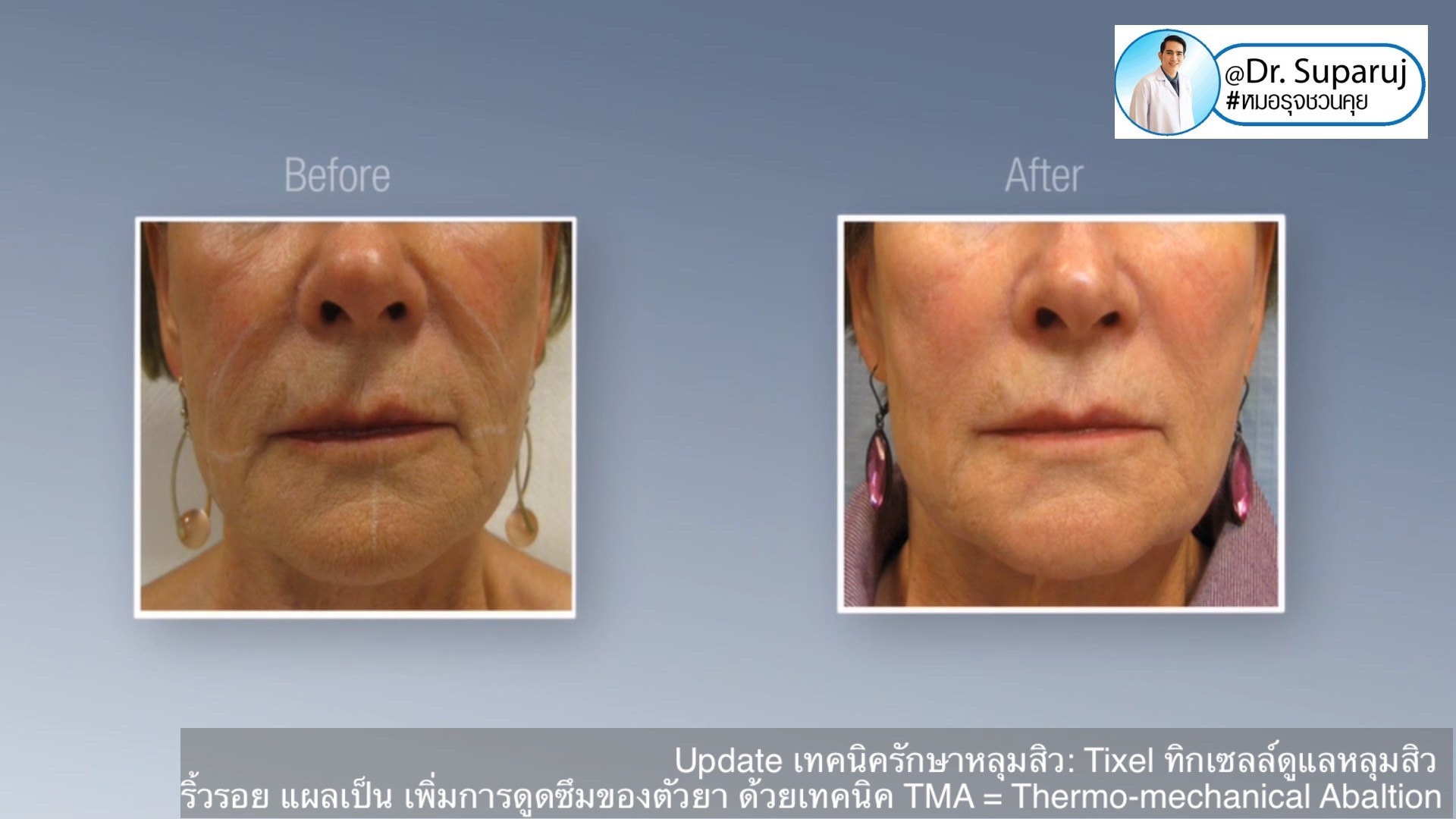 Update เทคนิครักษาหลุมสิว: Tixel ทิ๊กเซลล์ รักษาหลุมสิว ริ้วรอย แผลเป็น เพิ่มการดูดซึมยาด้วยเทคนิค TMA = Thermo-mechanical Abaltion Update เทคนิครักษาหลุมสิว: Tixel ทิ๊กเซลล์ รักษาหลุมสิว ริ้วรอย แผลเป็น เพิ่มการดูดซึมยาด้วยเทคนิค TMA = Thermo-mechanical Abaltion