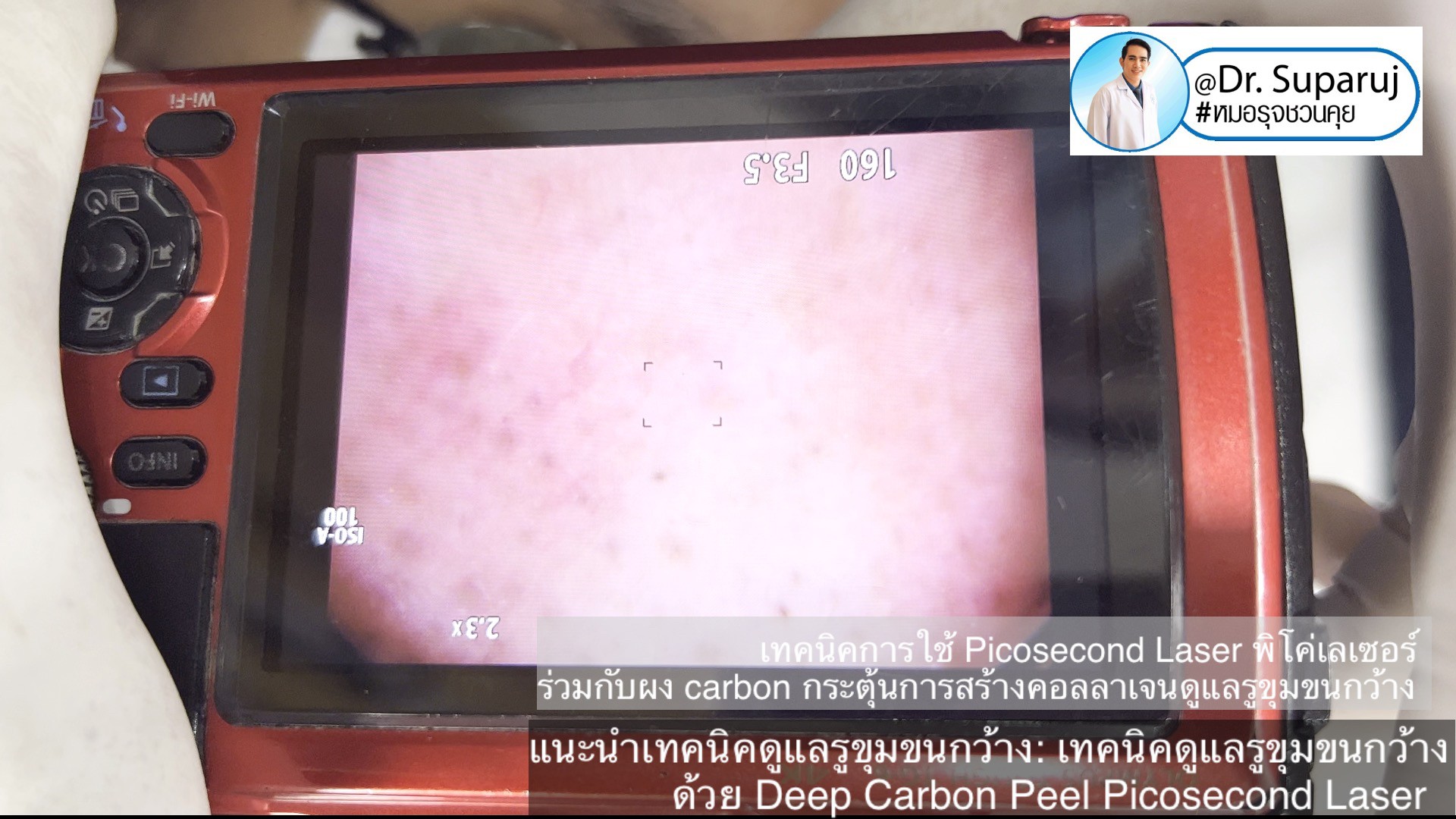 แนะนำเทคนิคดูแลรูขุมขนกว้าง: เทคนิคดูแลรูขุมขนกว้างด้วย Deep Carbon Peel Picosecond Laser (เทคนิคการใช้ Picosecond Laser พิโค่เลเซอร์ ร่วมกับผง carbon กระตุ้นการสร้างคอลลาเจนดูแลรูขุมขนกว้าง )