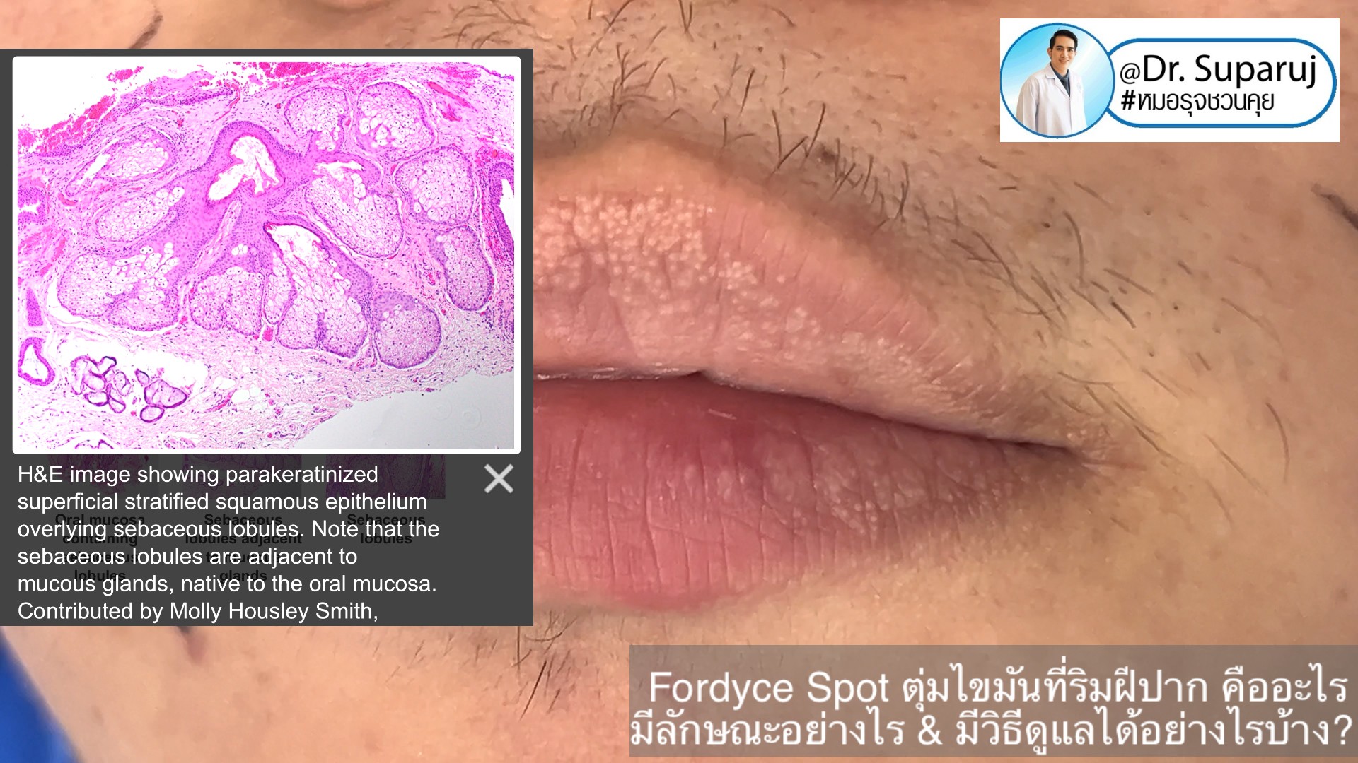 Fordyce Spot ตุ่มไขมันที่ริมฝีปาก คืออะไร มีลักษณะอย่างไร & มีวิธีดูแลได้อย่างไรบ้าง? Fordyce Spot ตุ่มไขมันที่ริมฝีปาก คืออะไร มีลักษณะอย่างไร & มีวิธีดูแลได้อย่างไรบ้าง?