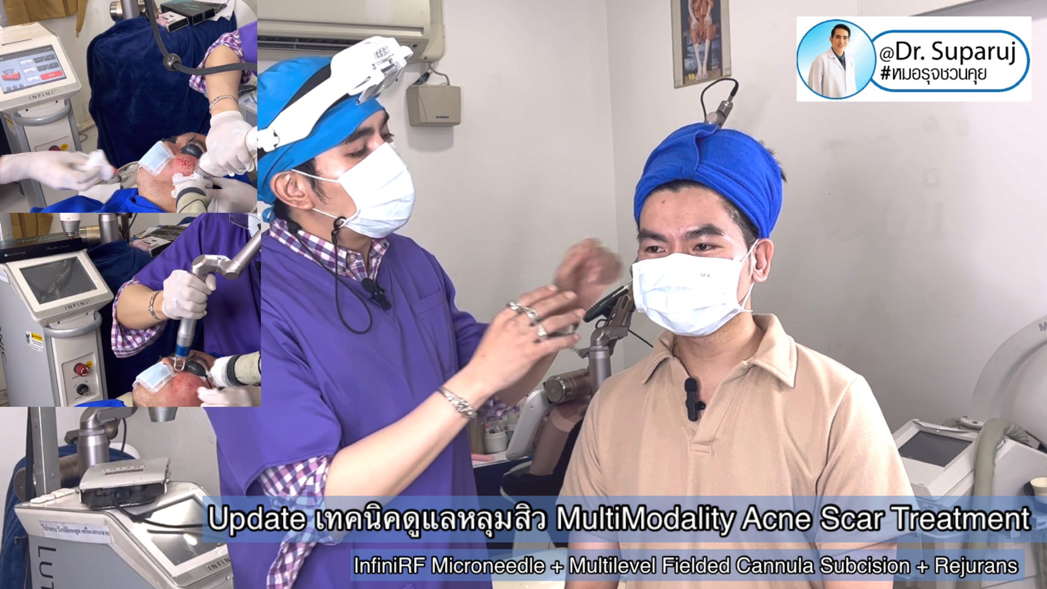 แนะนำเทคนิครักษาหลุมสิว: ดูแลหลุมสิวด้วยเข็มพลังงานคลื่นวิทยุ Infini RF Microneedle แนะนำเทคนิครักษาหลุมสิว: ดูแลหลุมสิวด้วยเข็มพลังงานคลื่นวิทยุ Infini RF Microneedle