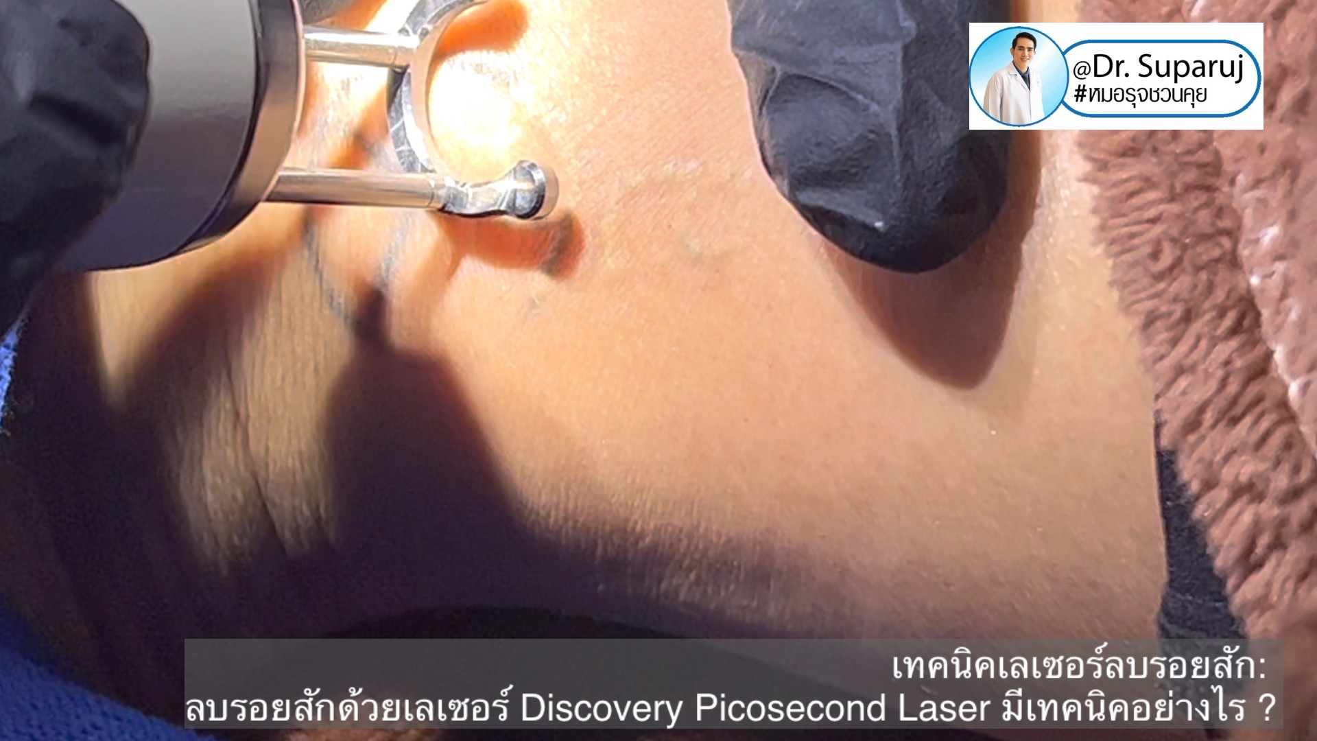 แนะนำเทคนิคเลเซอร์ลบรอยสักด้วย Picosecond Laser: ลบรอยสักด้วยเลเซอร์ Discovery Picosecond Laser มีเทคนิคอย่างไร ? แนะนำเทคนิคเลเซอร์ลบรอยสักด้วย Picosecond Laser: ลบรอยสักด้วยเลเซอร์ Discovery Picosecond Laser มีเทคนิคอย่างไร ?