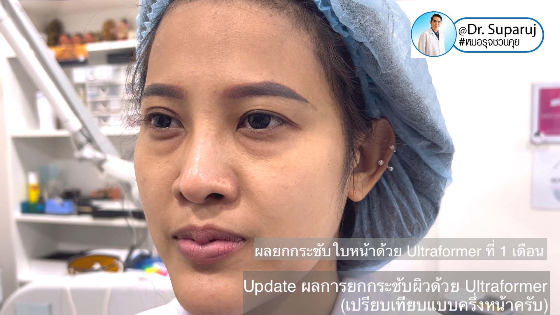 Update ผลการยกกระชับผิวด้วย Ultraformer III (เปรียบเทียบแบบครึ่งหน้าให้เห็นชัดๆครับ) Update ผลการยกกระชับผิวด้วย Ultraformer III (เปรียบเทียบแบบครึ่งหน้าให้เห็นชัดๆครับ)