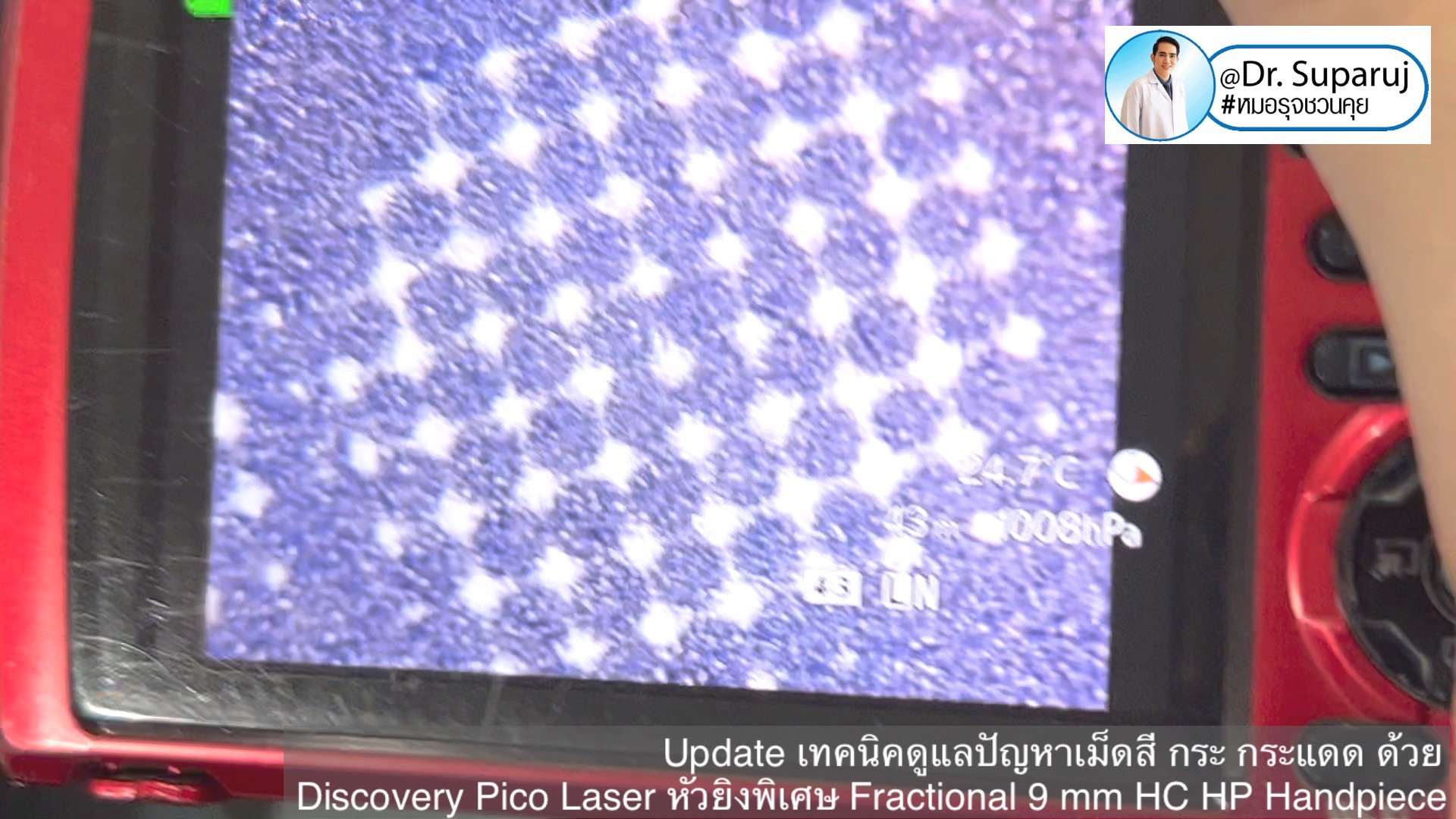 Update เทคนิคดูแลปัญหาเม็ดสี กระ กระแดด ด้วย Discovery Pico Laser หัวยิงเลเซอร์พิเศษ Fractional 9 mm HC HP Handpiece