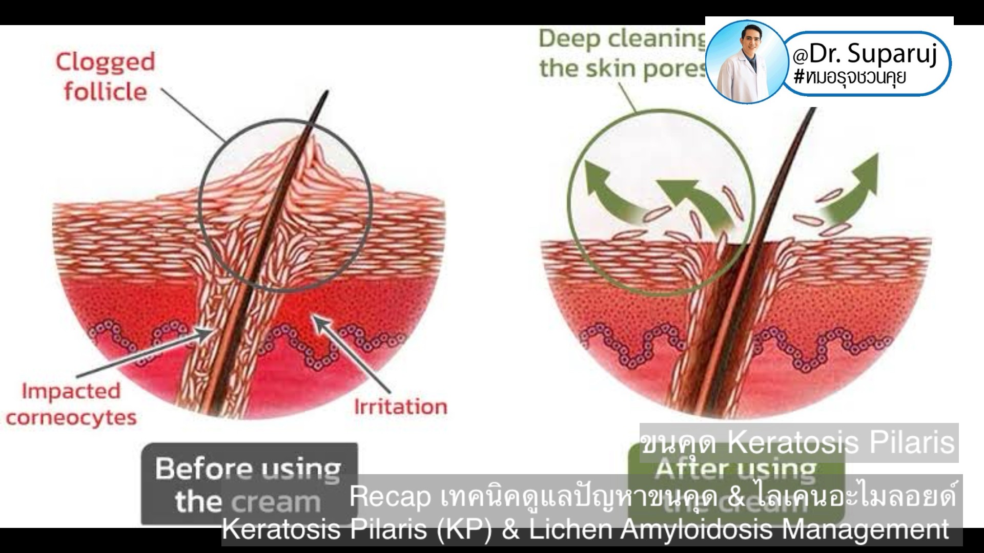 Recap เทคนิคดูแลปัญหาขนคุด & ไลเคนอะไมลอยด์ Keratosis Pilaris (KP) & Lichen Amyloidosis Management