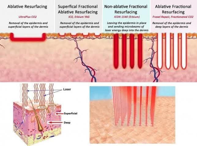 โปรแกรมเลเซอร์ Fractional CO2 Laser ยังใช้รักษาหลุมสิวได้อยู่ไหม ? โปรแกรมเลเซอร์ Fractional CO2 Laser ยังใช้รักษาหลุมสิวได้อยู่ไหม ?