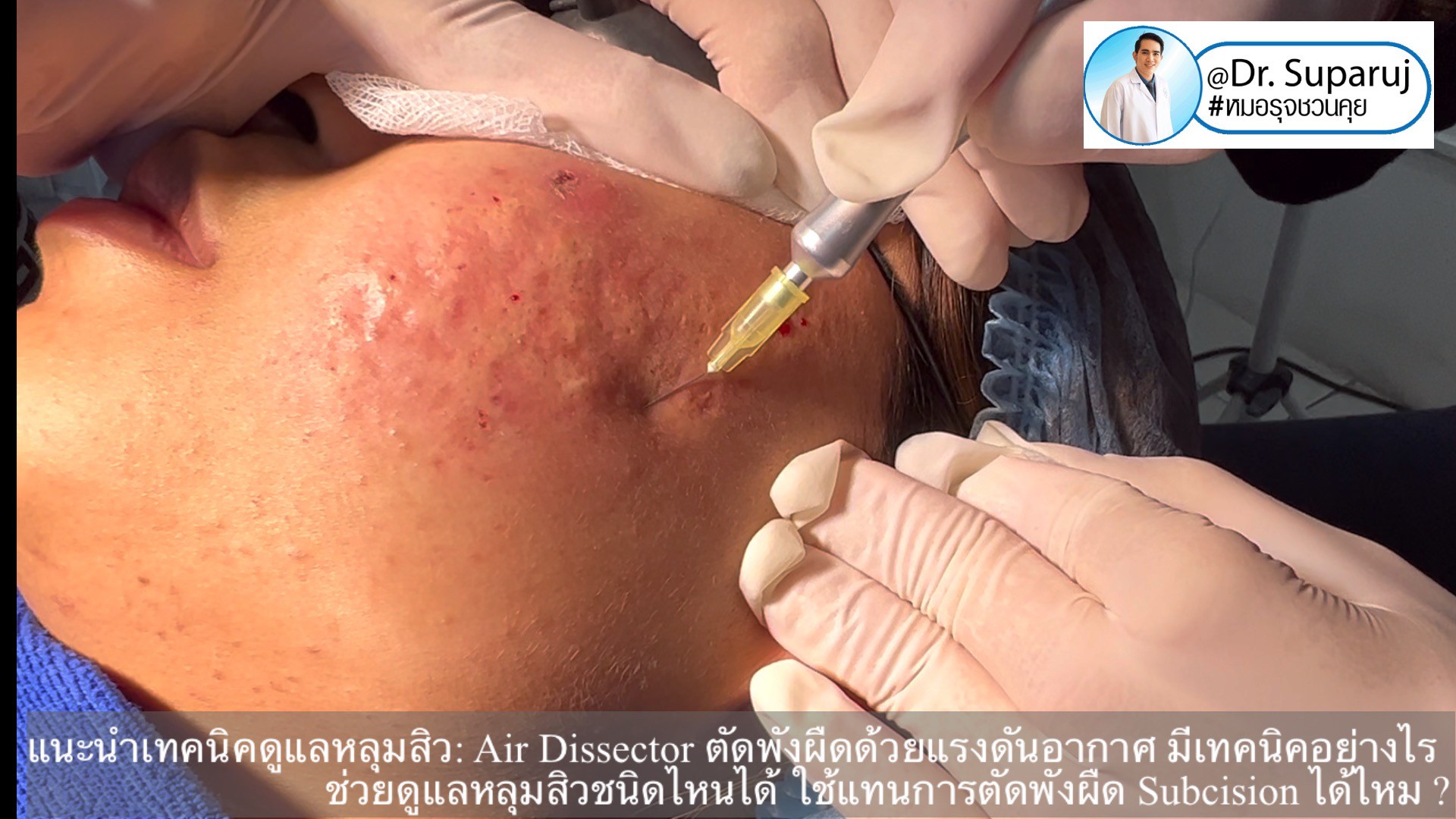 แนะนำเทคนิคดูแลหลุมสิว: Air Dissector ตัดพังผืดด้วยแรงดันอากาศ มีเทคนิคอย่างไร ช่วยดูแลหลุมสิวชนิดไหนได้ ใช้แทนการตัดพังผืด Subcision ได้ไหม ?