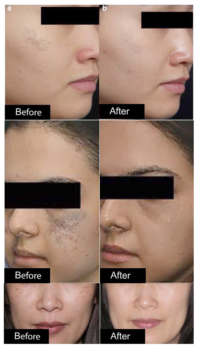เทคนิครักษากระโฮริ กระลึก ปานโฮริ (Hori's nevus) ด้วยเลเซอร์ Discovery Picosecond Laser เทคนิครักษากระโฮริ กระลึก ปานโฮริ (Hori's nevus) ด้วยเลเซอร์ Discovery Picosecond Laser