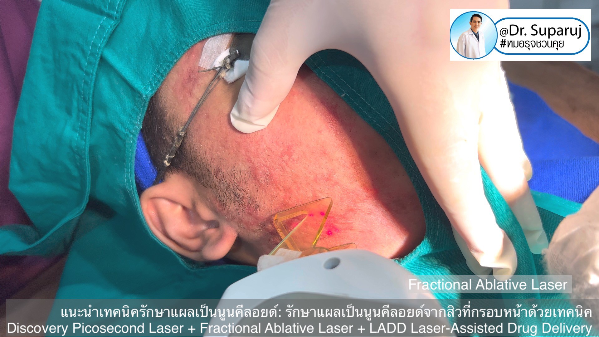 แนะนำเทคนิคดูแลแผลเป็นนูนคีลอยด์: รักษาแผลเป็นนูนคีลอยด์จากสิวที่กรอบหน้าด้วยเทคนิค Discovery Picosecond Laser + Fractional Ablative Laser + LADD Laser-Assisted Drug Delivery แนะนำเทคนิคดูแลแผลเป็นนูนคีลอยด์: รักษาแผลเป็นนูนคีลอยด์จากสิวที่กรอบหน้าด้วยเทคนิค Discovery Picosecond Laser + Fractional Ablative Laser + LADD Laser-Assisted Drug Delivery