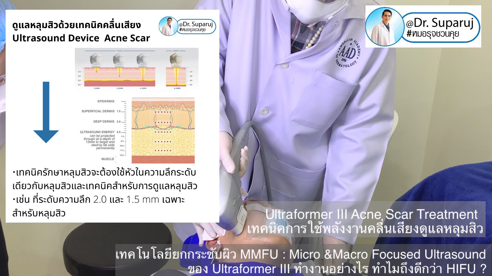 เทคโนโลยียกกระชับผิว MMFU : Micro &Macro Focused Ultrasound ของ Ultraformer III ทำงานอย่างไร ทำไมถึงดีกว่า HIFU ? เทคโนโลยียกกระชับผิว MMFU : Micro &Macro Focused Ultrasound ของ Ultraformer III ทำงานอย่างไร ทำไมถึงดีกว่า HIFU ?