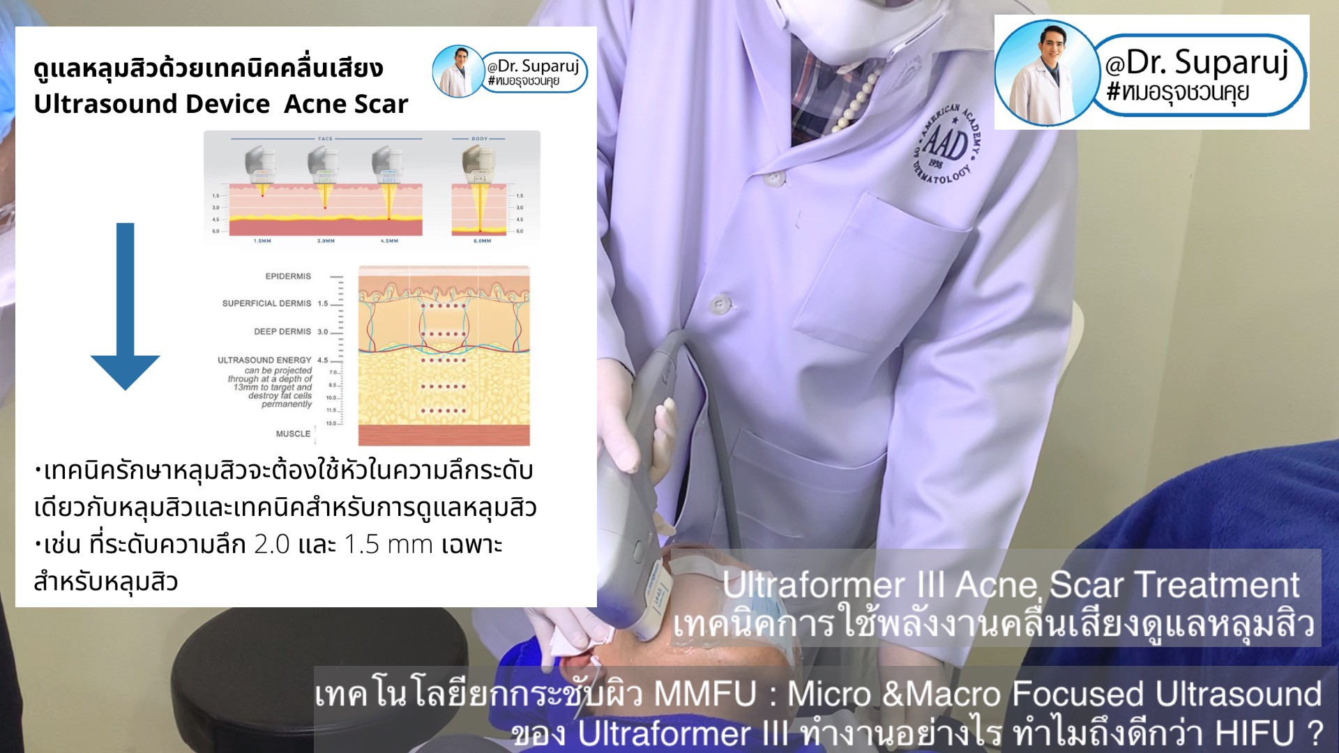 เทคโนโลยียกกระชับผิว MMFU : Micro &Macro Focused Ultrasound ของ Ultraformer III ทำงานอย่างไร ทำไมถึงดีกว่า HIFU ?