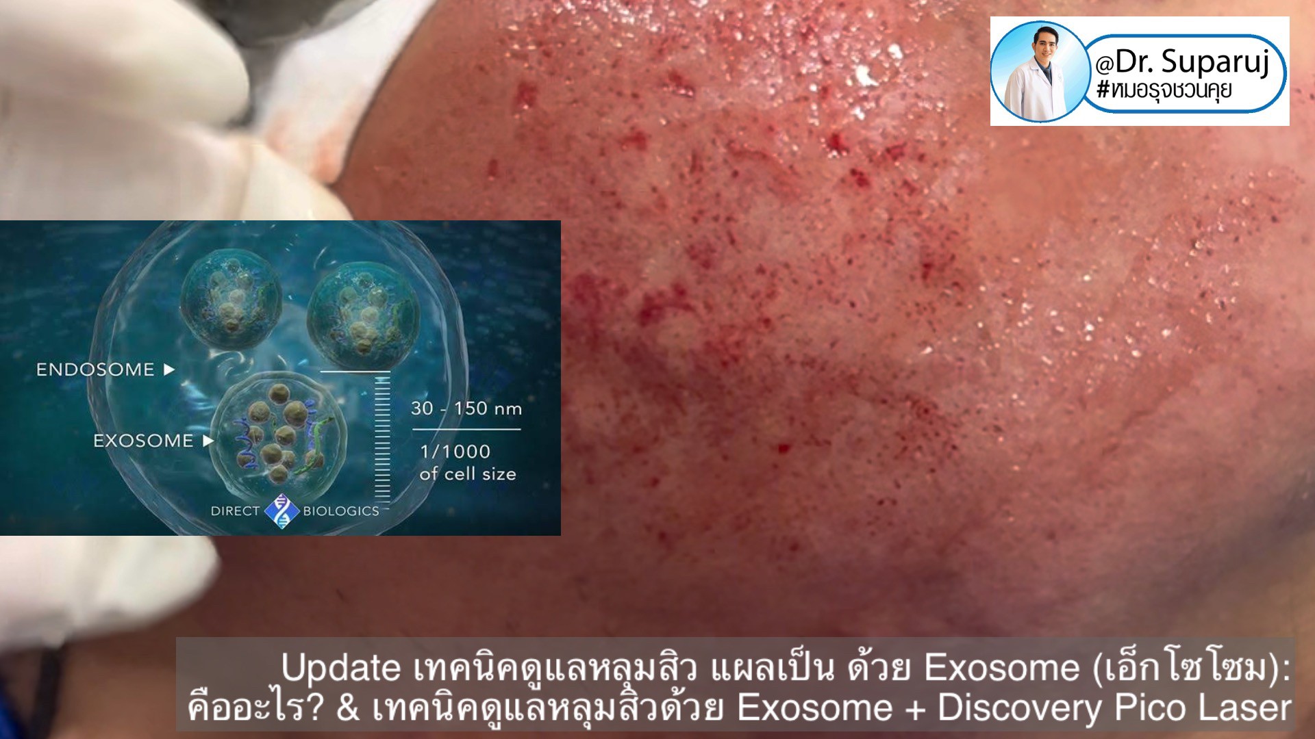 แนะนำเทคนิคในการดูแลหลุมสิว: Exosome ใน การรักษาหลุมสิว (Exosome & acne scar treatment) แนะนำเทคนิคในการดูแลหลุมสิว: Exosome ใน การรักษาหลุมสิว (Exosome & acne scar treatment)