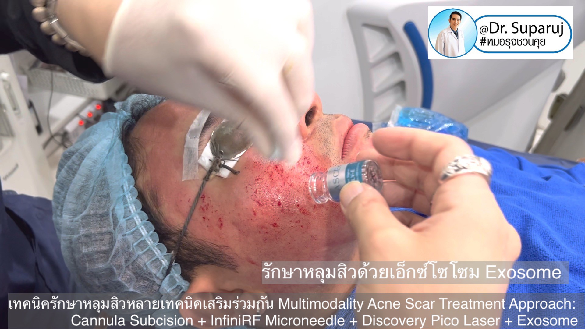 เทคนิครักษาหลุมสิวด้วยหลายเทคนิคเสริมร่วมกัน Multimodality Acne Scar Treatment Approach: Cannula Subcision + InfiniRF Microneedle + Discovery Pico Laser + Exosome เทคนิครักษาหลุมสิวด้วยหลายเทคนิคเสริมร่วมกัน Multimodality Acne Scar Treatment Approach: Cannula Subcision + InfiniRF Microneedle + Discovery Pico Laser + Exosome