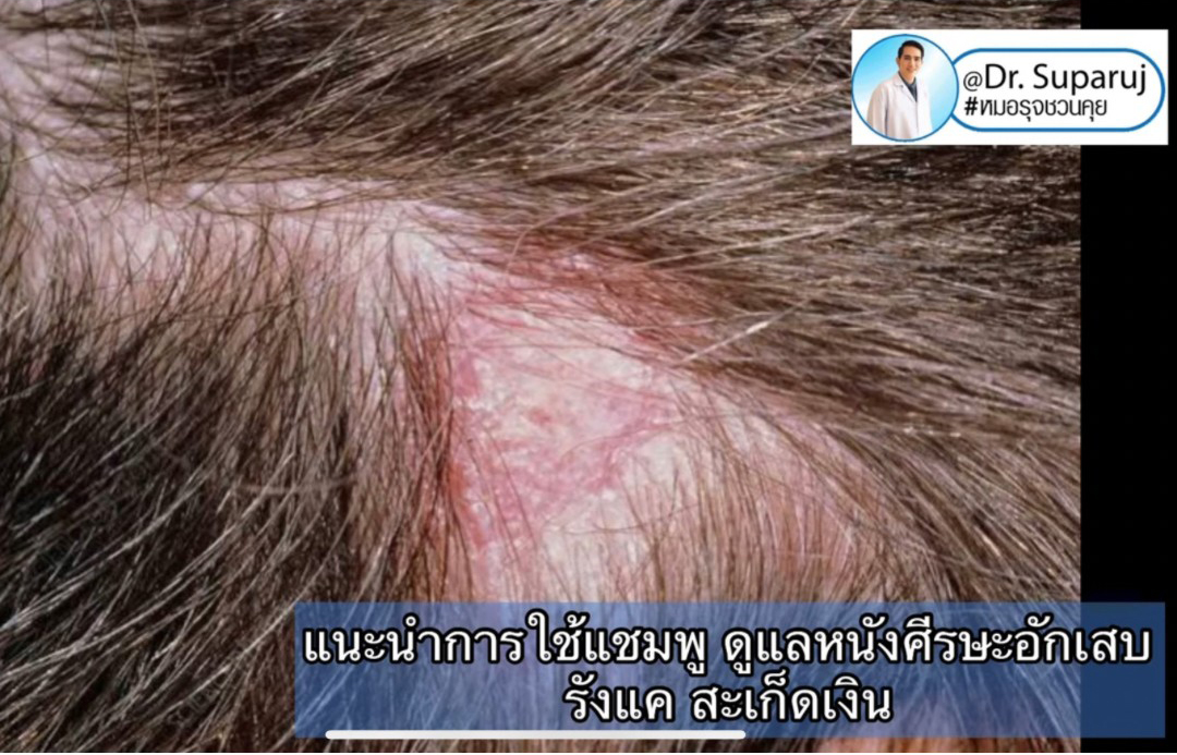 แนะนำเทคนิคการใช้แชมพู ดูแลหนังศีรษะอักเสบ รังแค เซ็บเดิร์ม สะเก็ดเงิน แนะนำเทคนิคการใช้แชมพู ดูแลหนังศีรษะอักเสบ รังแค เซ็บเดิร์ม สะเก็ดเงิน