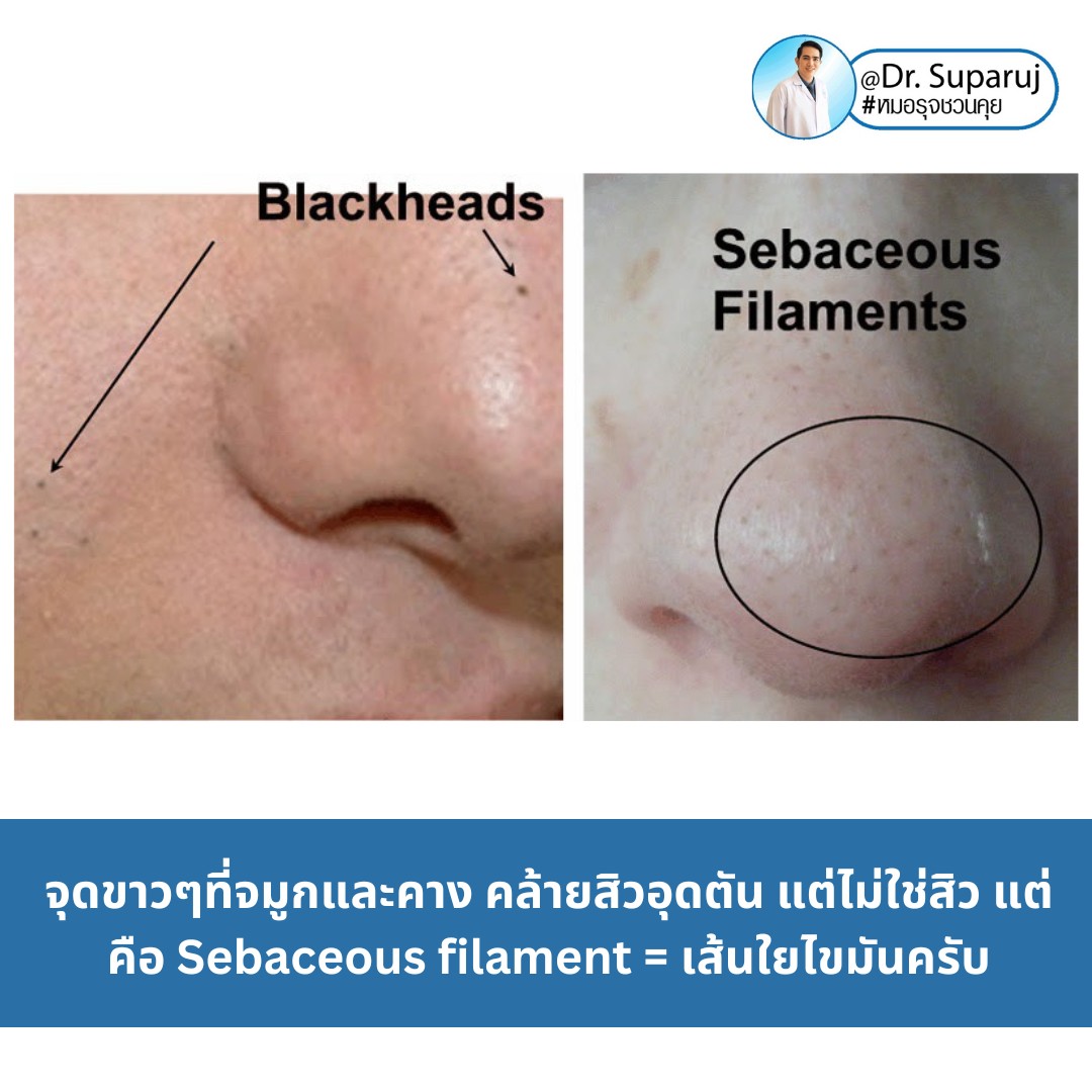 Sebaceous filament = เส้นใยไขมัน คืออะไรมี ?ลักษณะอย่างไร ? ดูแลได้อย่างไร? (คลิปเต็ม Full Clip YouTube Facebook: Dr. Suparuj ครับ Sebaceous filament = เส้นใยไขมัน คืออะไรมี ?ลักษณะอย่างไร ? ดูแลได้อย่างไร? (คลิปเต็ม Full Clip YouTube Facebook: Dr. Suparuj ครับ