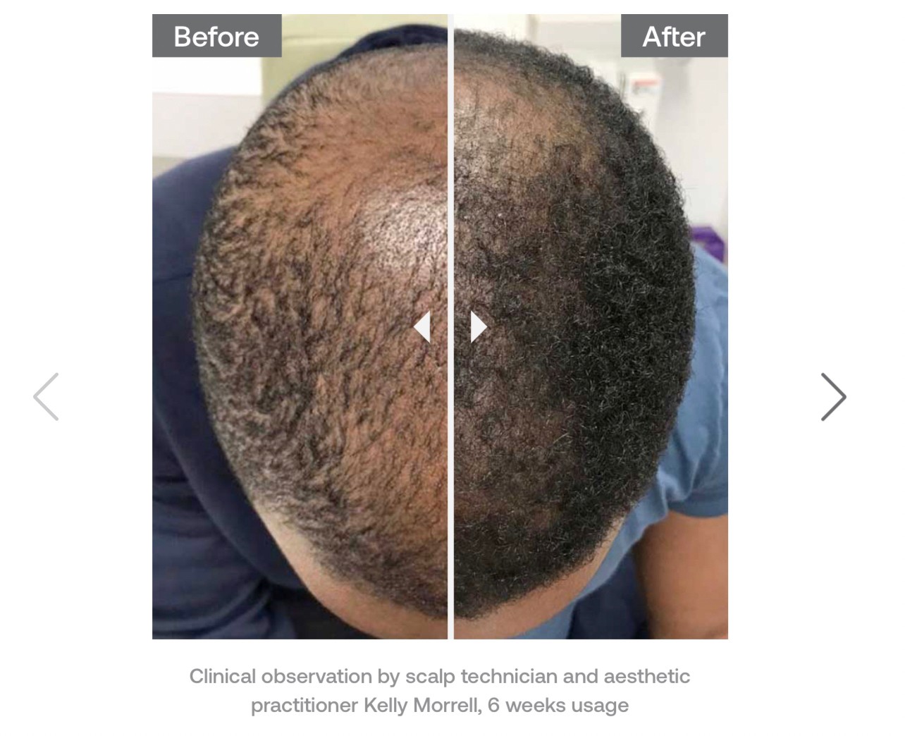 Update จากการประชุมแพทย์ผิวหนังระดับโลก WCD 2023: นวัตกรรมในการดูแลผมร่วงผมบางด้วยการใช้ Calecim Advanced Hair System Update จากการประชุมแพทย์ผิวหนังระดับโลก WCD 2023: นวัตกรรมในการดูแลผมร่วงผมบางด้วยการใช้ Calecim Advanced Hair System