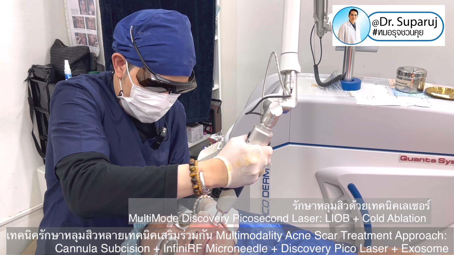 เทคนิครักษาหลุมสิวด้วยหลายเทคนิคเสริมร่วมกัน Multimodality Acne Scar Treatment Approach: Cannula Subcision + InfiniRF Microneedle + Discovery Pico Laser + Exosome