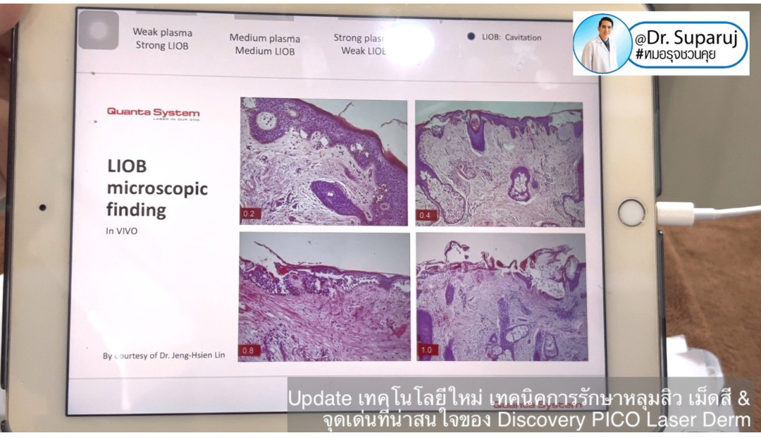 Update เทคโนโลยีใหม่ เทคนิคการรักษาหลุมสิว เม็ดสี & จุดเด่นที่น่าสนใจของ Discovery PICO Laser Derm Update เทคโนโลยีใหม่ เทคนิคการรักษาหลุมสิว เม็ดสี & จุดเด่นที่น่าสนใจของ Discovery PICO Laser Derm