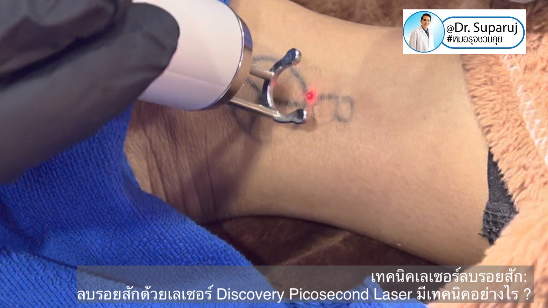 แนะนำเทคนิคเลเซอร์ลบรอยสักด้วย Picosecond Laser: ลบรอยสักด้วยเลเซอร์ Discovery Picosecond Laser มีเทคนิคอย่างไร ? แนะนำเทคนิคเลเซอร์ลบรอยสักด้วย Picosecond Laser: ลบรอยสักด้วยเลเซอร์ Discovery Picosecond Laser มีเทคนิคอย่างไร ?