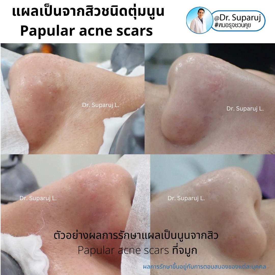 เทคนิคดูแลแผลเป็นตุ่มนูนจากสิว Papular acne scar ที่จมูก + คาง ด้วย Fractional Discovery Picosecond Laser + Deep Focused Ablative Laser เทคนิคดูแลแผลเป็นตุ่มนูนจากสิว Papular acne scar ที่จมูก + คาง ด้วย Fractional Discovery Picosecond Laser + Deep Focused Ablative Laser