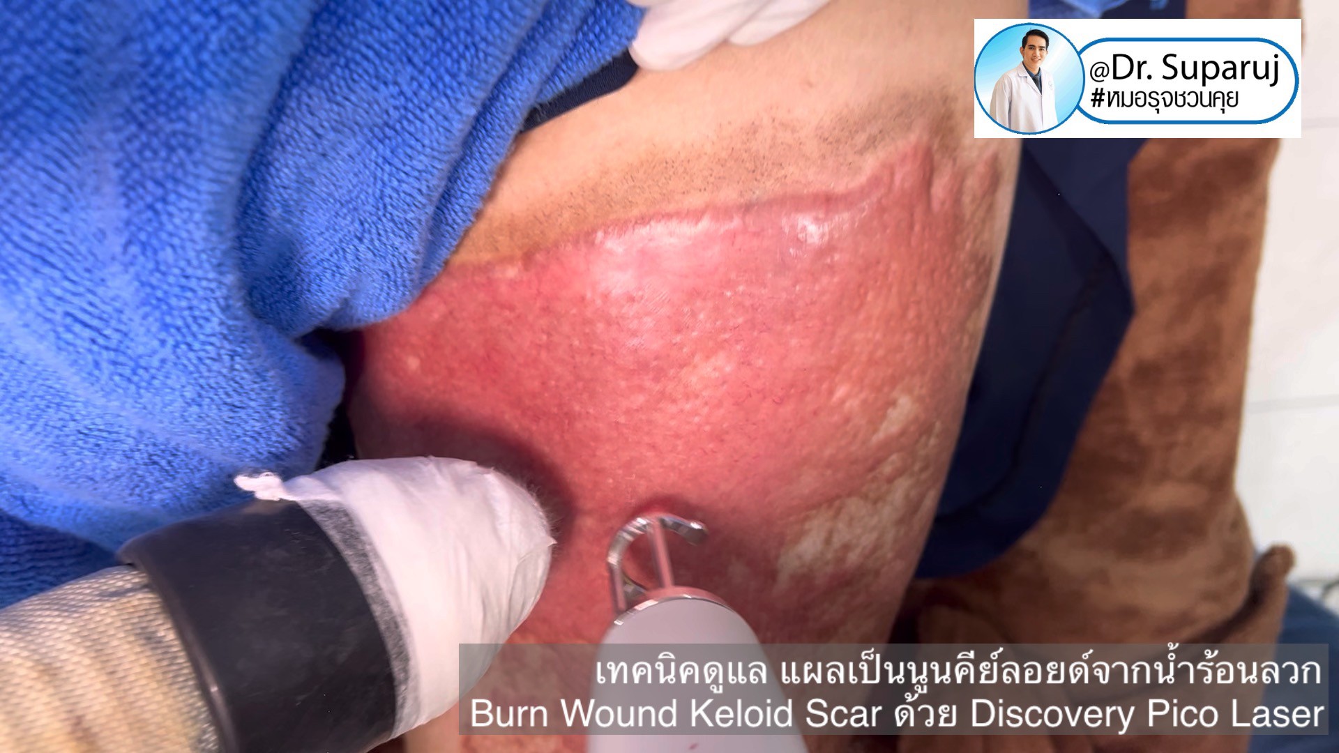 แนะนำเทคนิคดูแลแผลเป็น: เทคนิคดูแล แผลเป็นนูนคีย์ลอยด์จากน้ำร้อนลวก Burn Wound Keloid Scar ด้วย Discovery Pico Laser