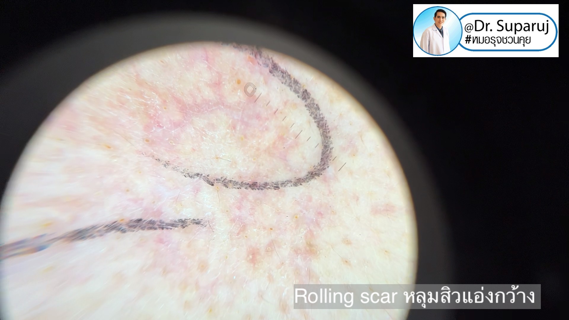 Back to the Basics: หลุมสิวมีกี่ชนิด & มีลักษณะอย่างไร ? Acne Scar Classification Full Clip คลิปเต็ม Facebook/ YouTube Dr. Suparuj หมอรุจชวนคุย ครับ Back to the Basics: หลุมสิวมีกี่ชนิด & มีลักษณะอย่างไร ? Acne Scar Classification Full Clip คลิปเต็ม Facebook/ YouTube Dr. Suparuj หมอรุจชวนคุย ครับ