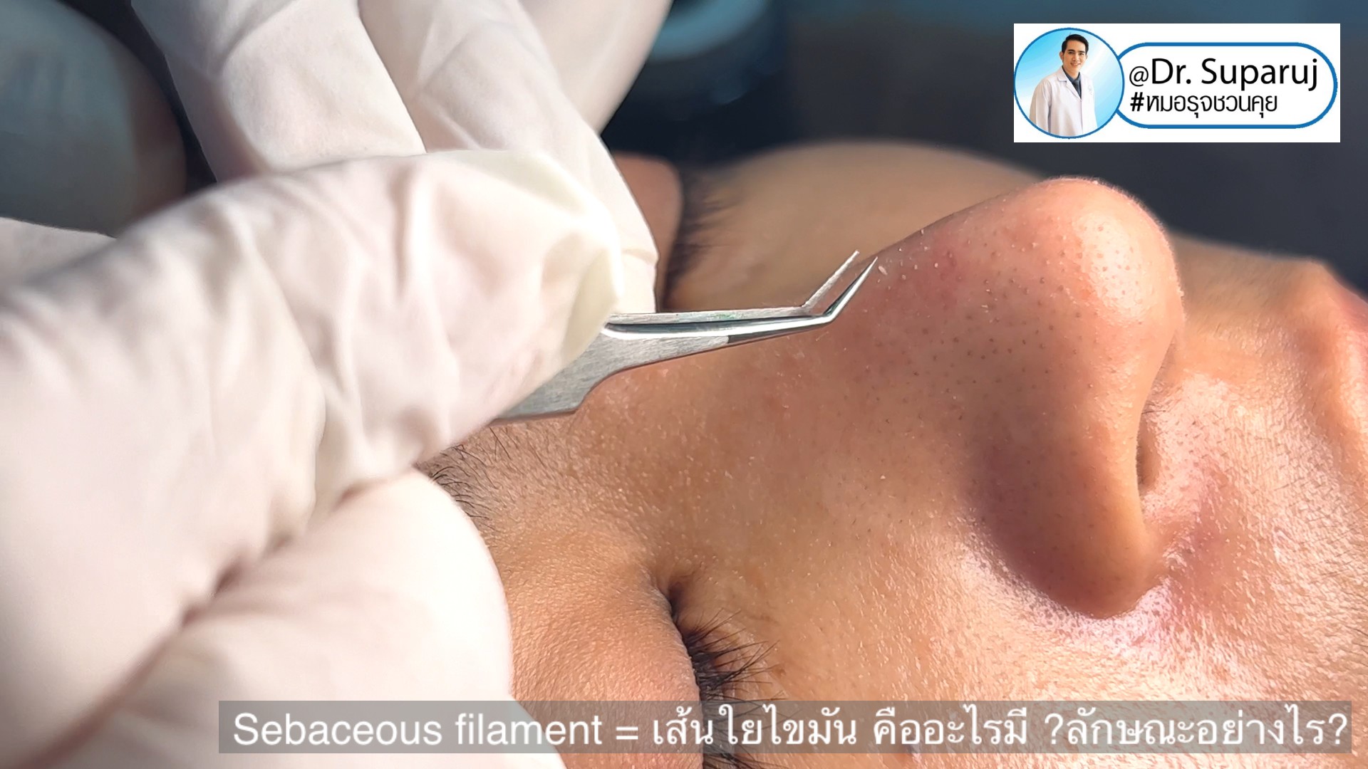 Sebaceous filament = เส้นใยไขมัน คืออะไรมี ?ลักษณะอย่างไร ? ดูแลได้อย่างไร? (คลิปเต็ม Full Clip YouTube Facebook: Dr. Suparuj ครับ