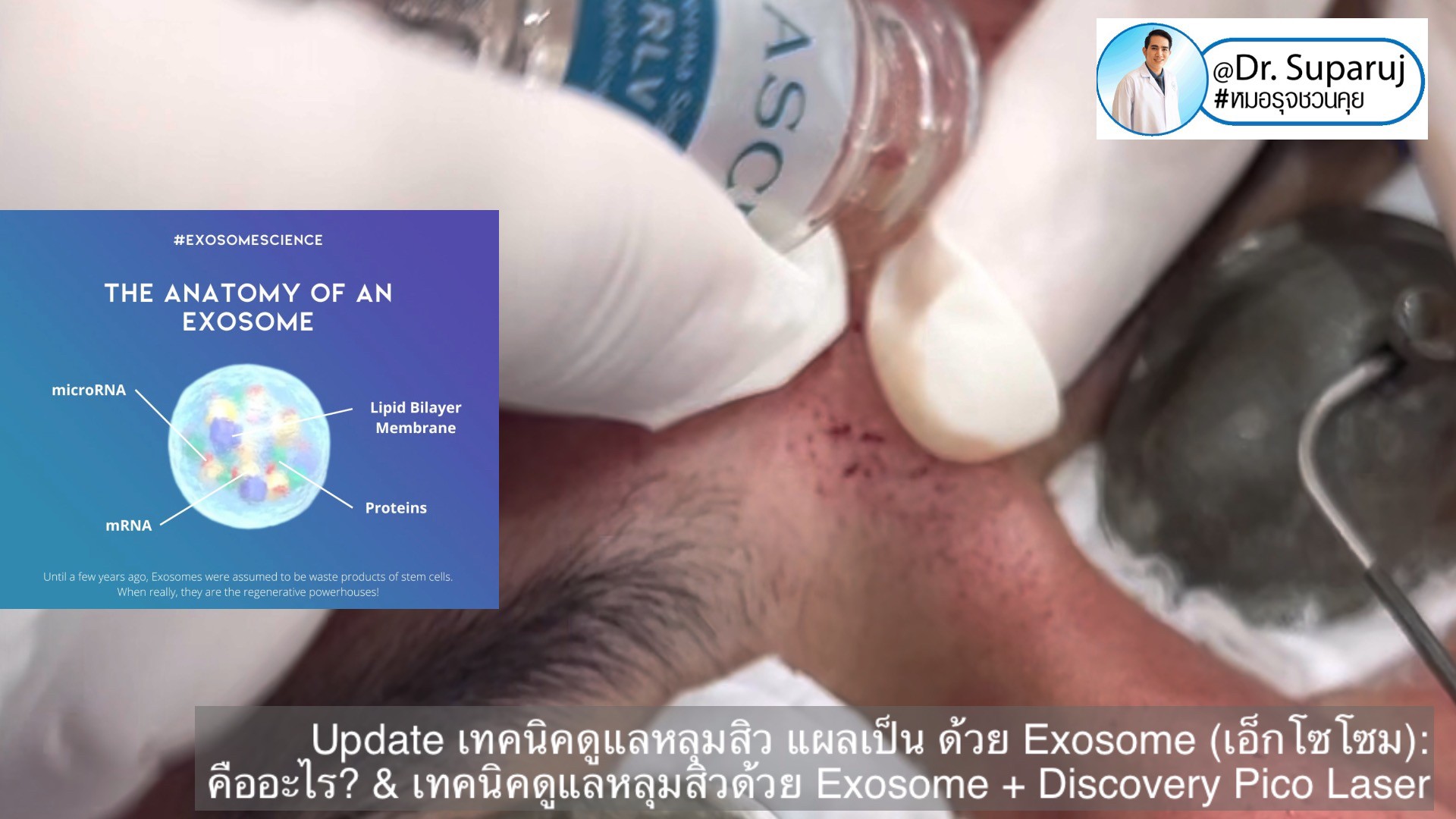 แนะนำเทคนิคในการดูแลหลุมสิว: Exosome ใน การรักษาหลุมสิว (Exosome & acne scar treatment) แนะนำเทคนิคในการดูแลหลุมสิว: Exosome ใน การรักษาหลุมสิว (Exosome & acne scar treatment)