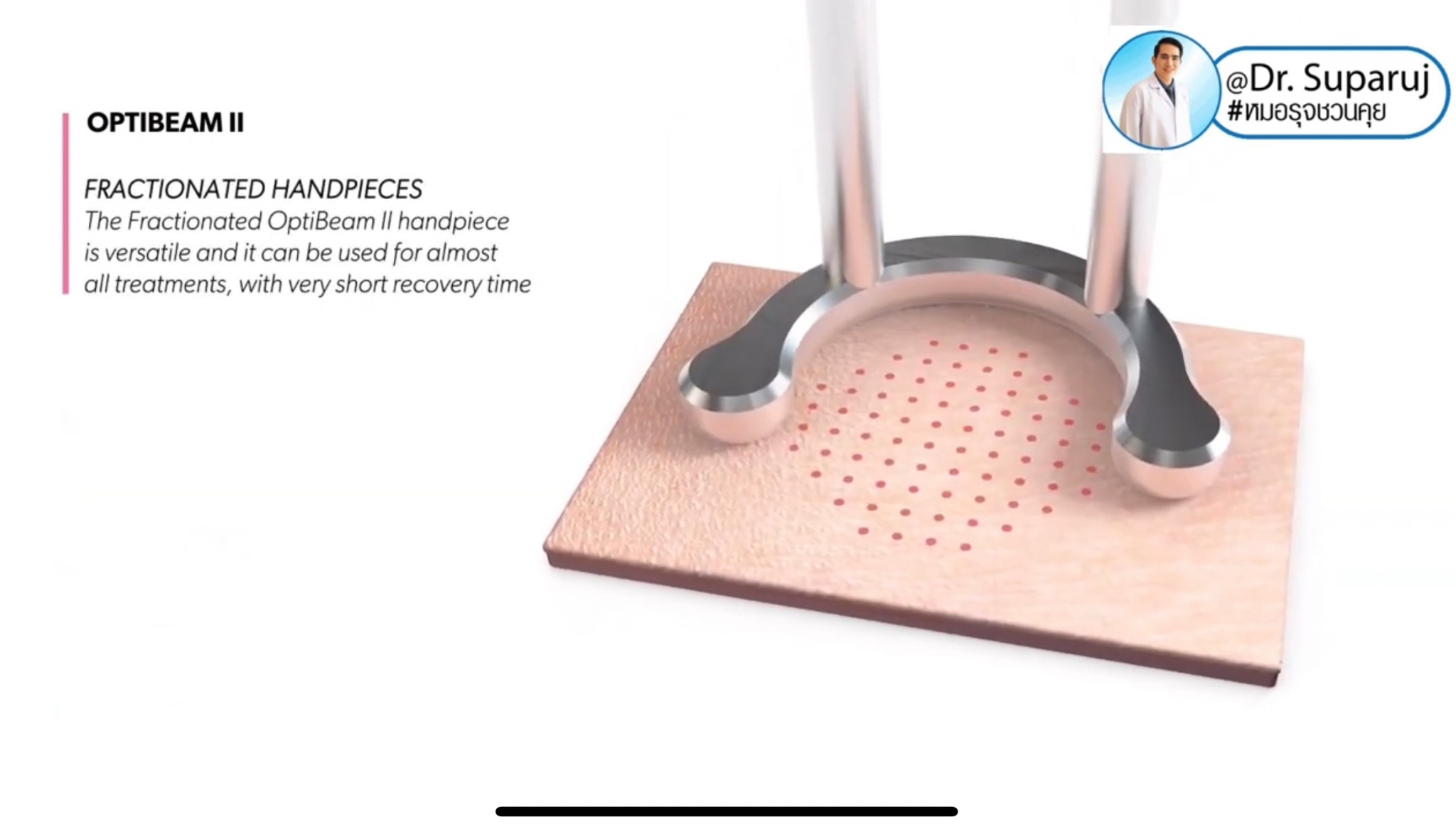 แนะนำเทคนิคดูแลริมฝีปากคล้ำ Lip Hyperpigmentation ริ้วรอย ริ้วรอยรอบริมฝีปาก: สาเหตุ การดูแล & เทคนิคเลเซอร์ MultiMode Discovery Picosecond Laser Lip Rejuvenation แนะนำเทคนิคดูแลริมฝีปากคล้ำ Lip Hyperpigmentation ริ้วรอย ริ้วรอยรอบริมฝีปาก: สาเหตุ การดูแล & เทคนิคเลเซอร์ MultiMode Discovery Picosecond Laser Lip Rejuvenation