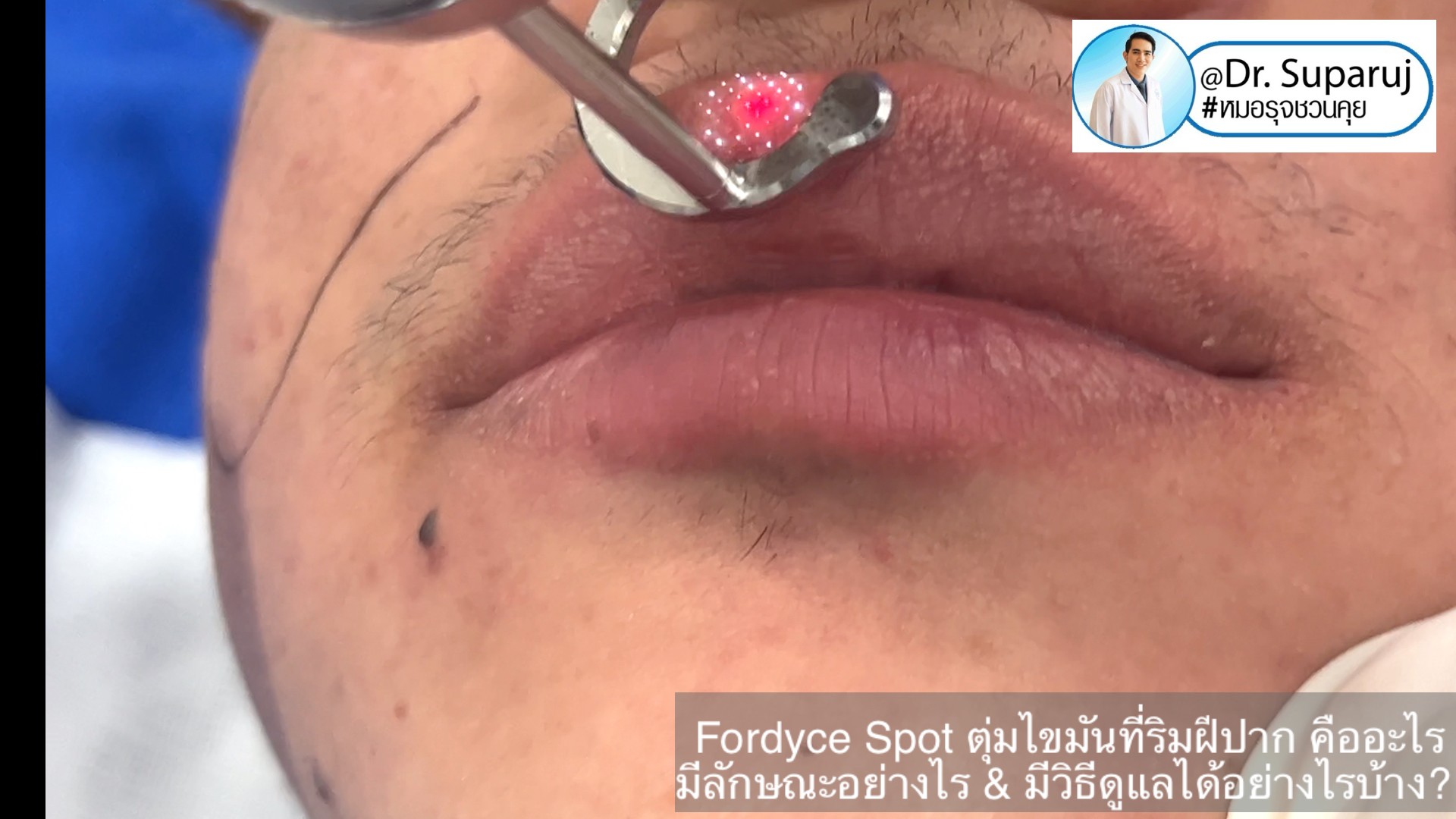 Fordyce Spot ตุ่มไขมันที่ริมฝีปาก คืออะไร มีลักษณะอย่างไร & มีวิธีดูแลได้อย่างไรบ้าง? Fordyce Spot ตุ่มไขมันที่ริมฝีปาก คืออะไร มีลักษณะอย่างไร & มีวิธีดูแลได้อย่างไรบ้าง?