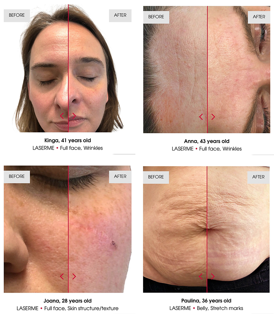Techniques for managing acne scars, textural scarring, and enlarged pores with a Fractional Non-Ablative 1470-nm Laser: LaserME Program Techniques for managing acne scars, textural scarring, and enlarged pores with a Fractional Non-Ablative 1470-nm Laser: LaserME Program