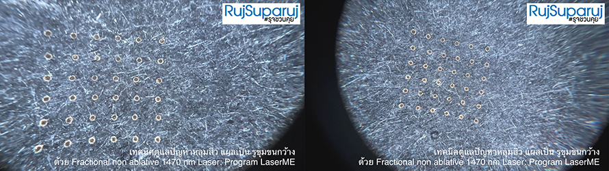 เทคนิคดูแลปัญหาหลุมสิว ด้วย Fractional non ablative 1470 nm Laser: Program LaserME เทคนิคดูแลปัญหาหลุมสิว ด้วย Fractional non ablative 1470 nm Laser: Program LaserME