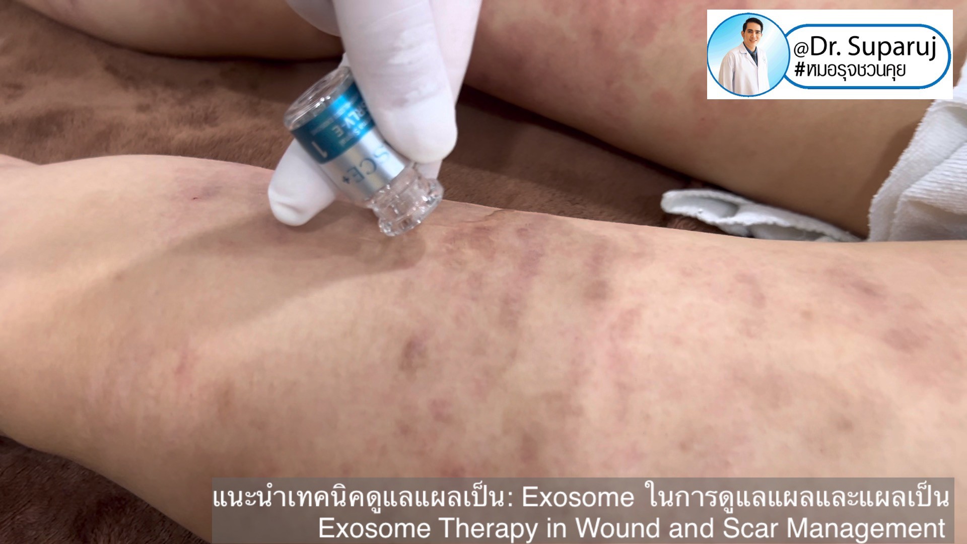 แนะนำเทคนิคดูแลแผลเป็น: Exosome ในการดูแลแผลและแผลเป็น Exosome Therapy in Wound and Scar Management แนะนำเทคนิคดูแลแผลเป็น: Exosome ในการดูแลแผลและแผลเป็น Exosome Therapy in Wound and Scar Management