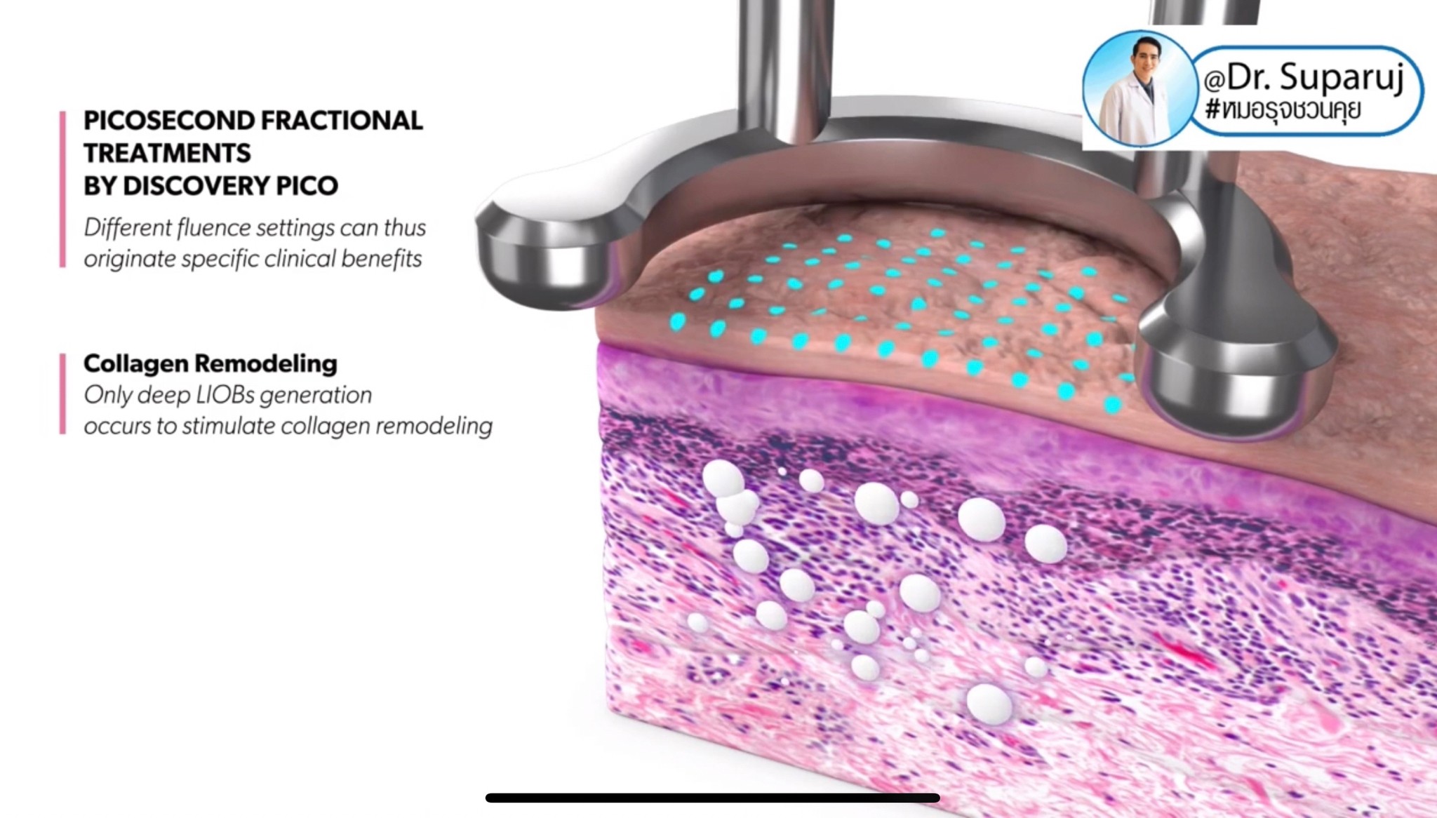 แนะนำเทคนิคดูแลริมฝีปากคล้ำ Lip Hyperpigmentation ริ้วรอย ริ้วรอยรอบริมฝีปาก: สาเหตุ การดูแล & เทคนิคเลเซอร์ MultiMode Discovery Picosecond Laser Lip Rejuvenation แนะนำเทคนิคดูแลริมฝีปากคล้ำ Lip Hyperpigmentation ริ้วรอย ริ้วรอยรอบริมฝีปาก: สาเหตุ การดูแล & เทคนิคเลเซอร์ MultiMode Discovery Picosecond Laser Lip Rejuvenation