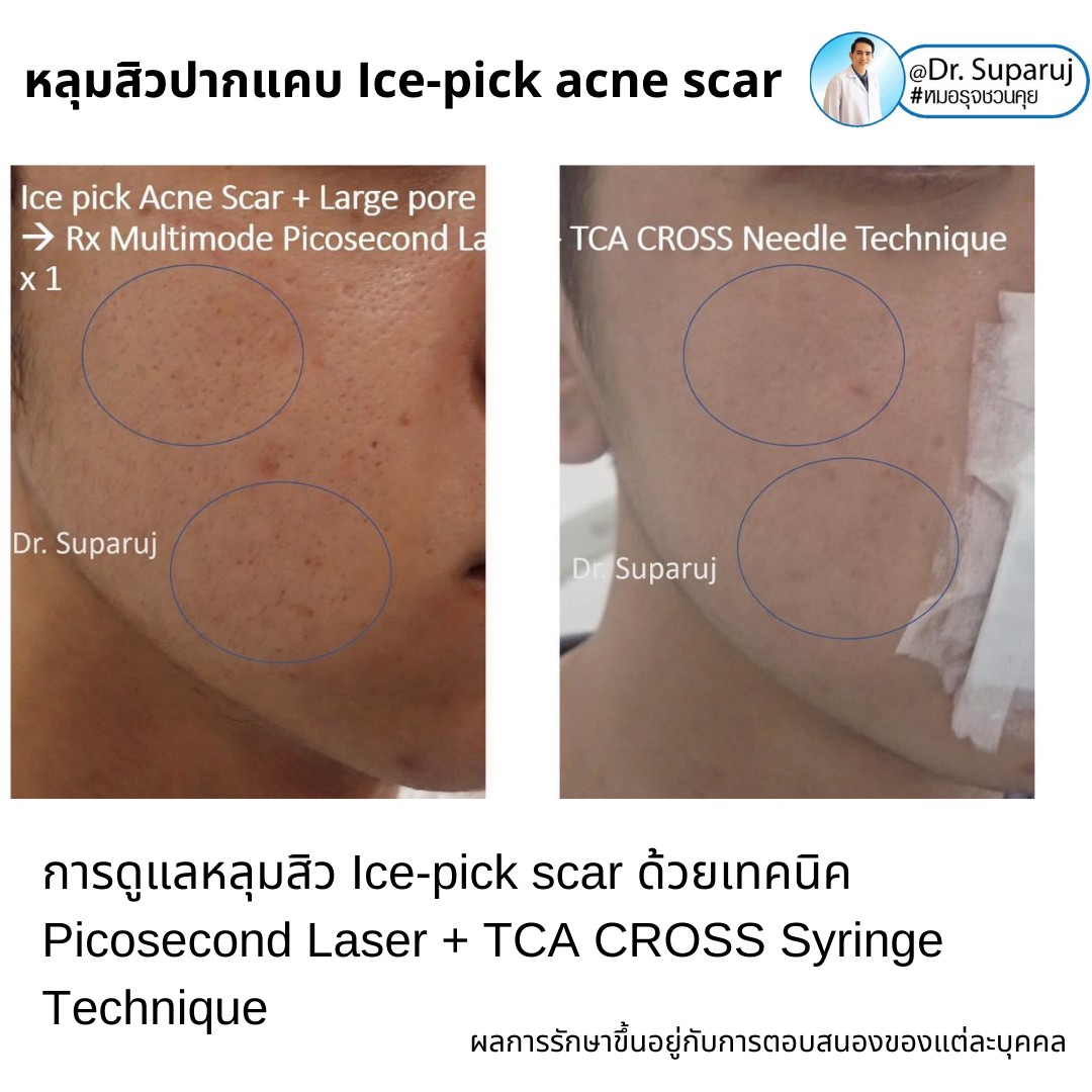 แนะนำเทคนิครักษาหลุมสิวจิกลึก Ice Pick Acne Scar ด้วยเทคนิคเลเซอร์ UltraDeep Pico Technique (Ice Pick Acne Scar Treatment with Discovery Pico Laser + UltraDeep Pico Technique) แนะนำเทคนิครักษาหลุมสิวจิกลึก Ice Pick Acne Scar ด้วยเทคนิคเลเซอร์ UltraDeep Pico Technique (Ice Pick Acne Scar Treatment with Discovery Pico Laser + UltraDeep Pico Technique)