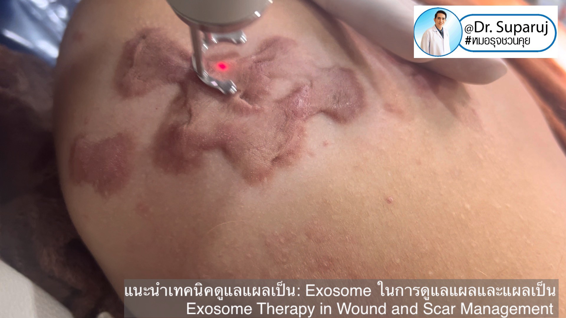 แนะนำเทคนิคดูแลแผลเป็น: Exosome ในการดูแลแผลและแผลเป็น Exosome Therapy in Wound and Scar Management แนะนำเทคนิคดูแลแผลเป็น: Exosome ในการดูแลแผลและแผลเป็น Exosome Therapy in Wound and Scar Management