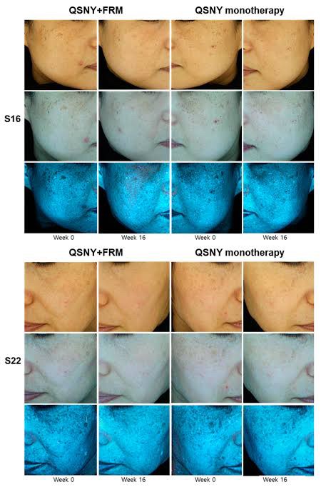 แนะนำเทคนิคดูแลฝ้า ด้วย SYLFIRM X Plus (SYLFIRMX Plus Fractional Radiofrequency Microneedle to Treat Melasma)