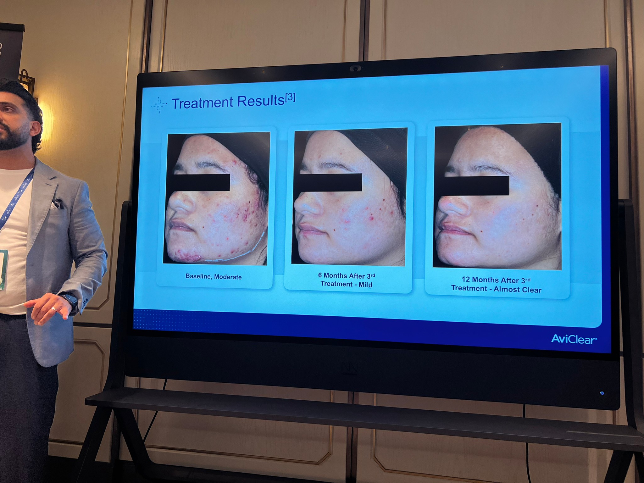 Update เครื่องเลเซอร์สำหรับรักษาสิวโดยเฉพาะ จับกับต่อมไขมันโดยตรง = AviClear 1726 nm Laser Update เครื่องเลเซอร์สำหรับรักษาสิวโดยเฉพาะ จับกับต่อมไขมันโดยตรง = AviClear 1726 nm Laser