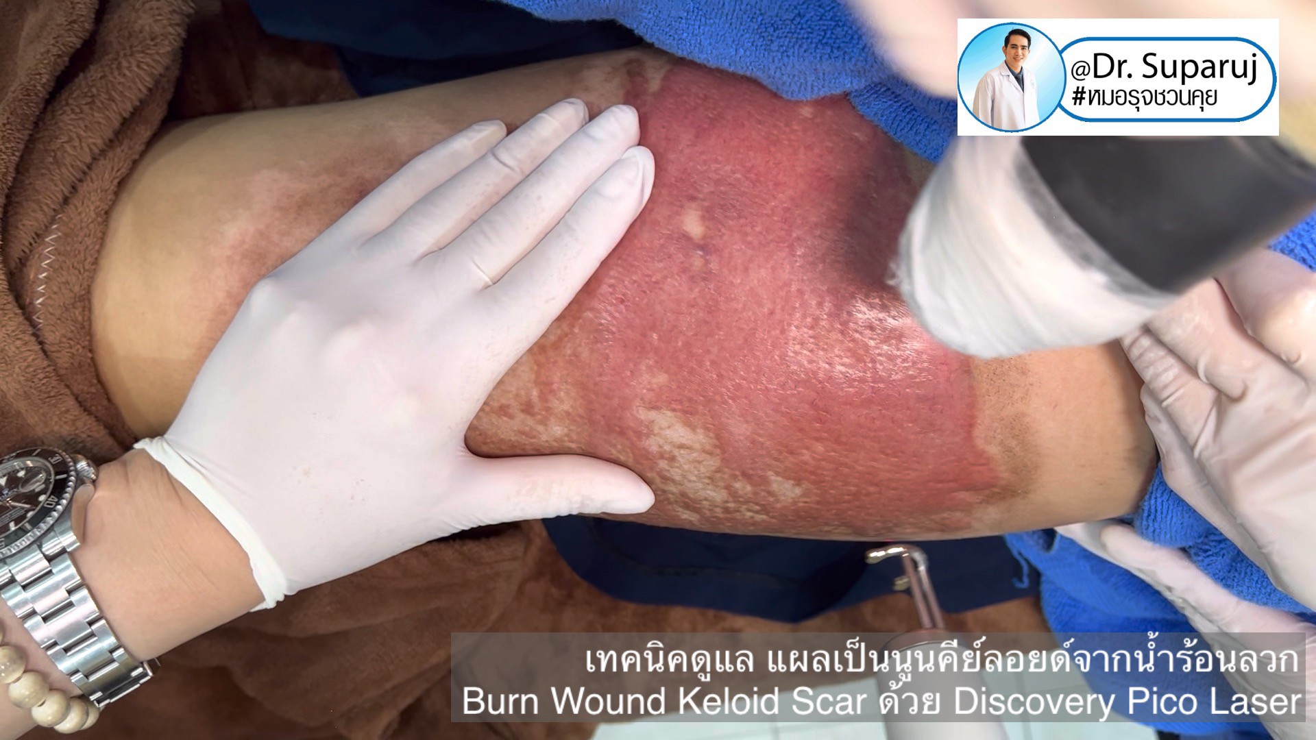 แนะนำเทคนิคดูแลแผลเป็น: เทคนิคดูแล แผลเป็นนูนคีย์ลอยด์จากน้ำร้อนลวก Burn Wound Keloid Scar ด้วย Discovery Pico Laser แนะนำเทคนิคดูแลแผลเป็น: เทคนิคดูแล แผลเป็นนูนคีย์ลอยด์จากน้ำร้อนลวก Burn Wound Keloid Scar ด้วย Discovery Pico Laser