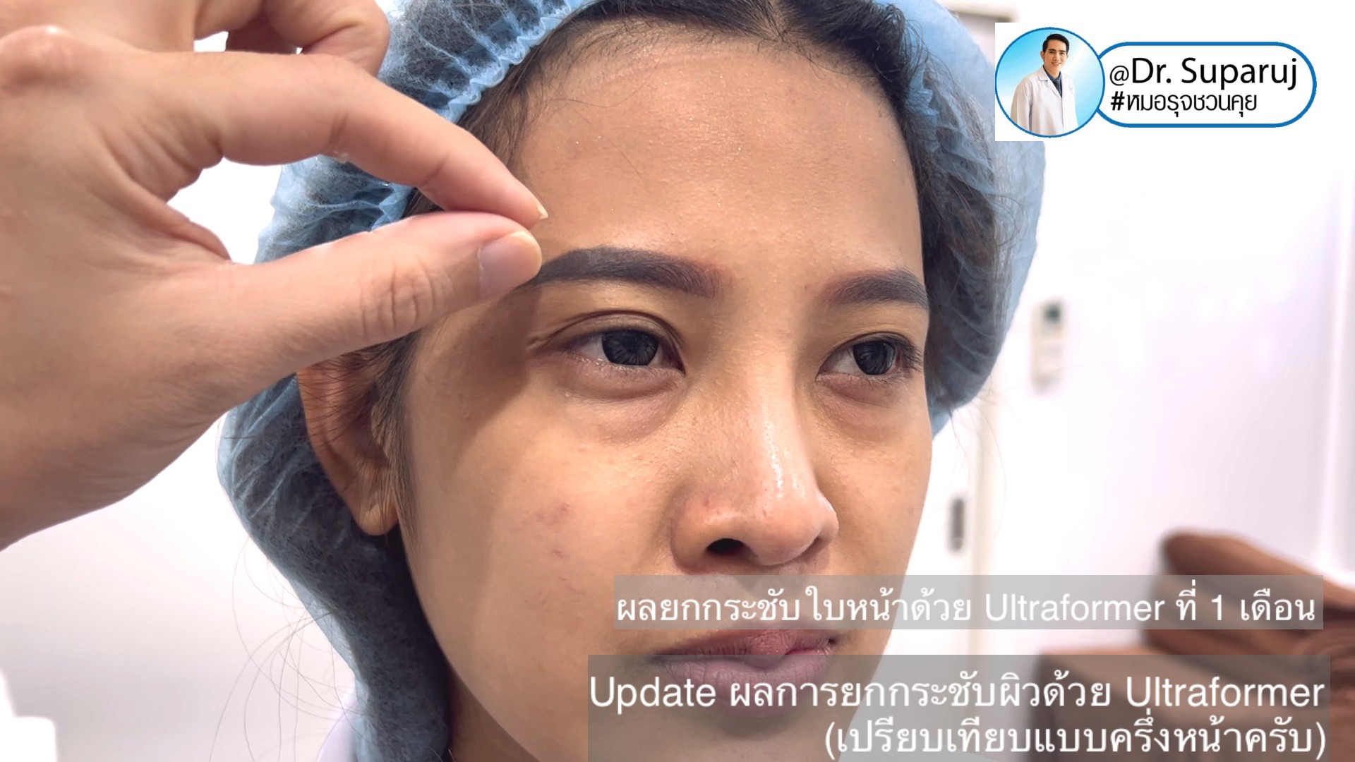 Update ผลการยกกระชับผิวด้วย Ultraformer III (เปรียบเทียบแบบครึ่งหน้าให้เห็นชัดๆครับ) Update ผลการยกกระชับผิวด้วย Ultraformer III (เปรียบเทียบแบบครึ่งหน้าให้เห็นชัดๆครับ)