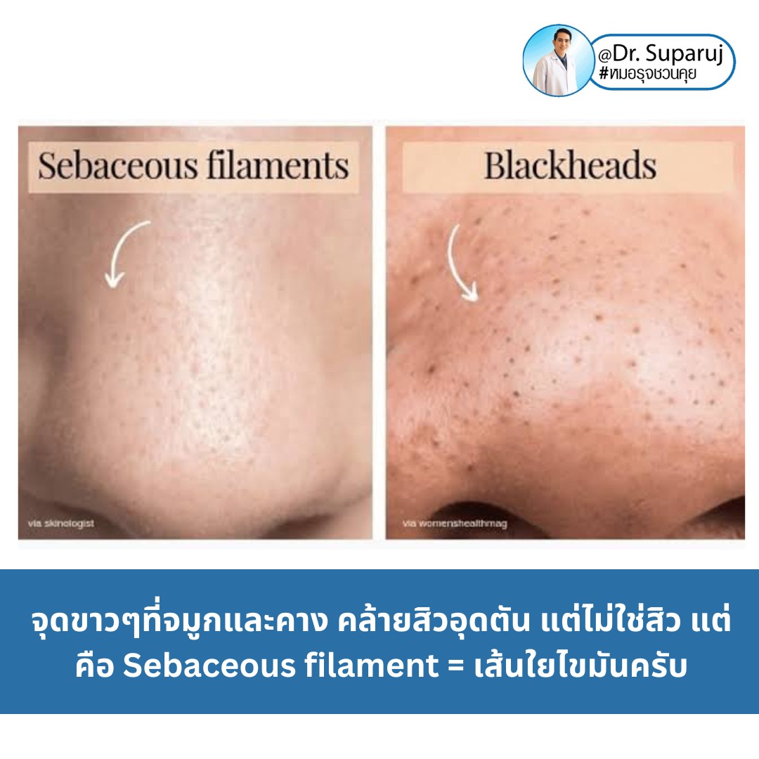 Sebaceous filament = เส้นใยไขมัน คืออะไรมี ?ลักษณะอย่างไร ? ดูแลได้อย่างไร? (คลิปเต็ม Full Clip YouTube Facebook: Dr. Suparuj ครับ Sebaceous filament = เส้นใยไขมัน คืออะไรมี ?ลักษณะอย่างไร ? ดูแลได้อย่างไร? (คลิปเต็ม Full Clip YouTube Facebook: Dr. Suparuj ครับ
