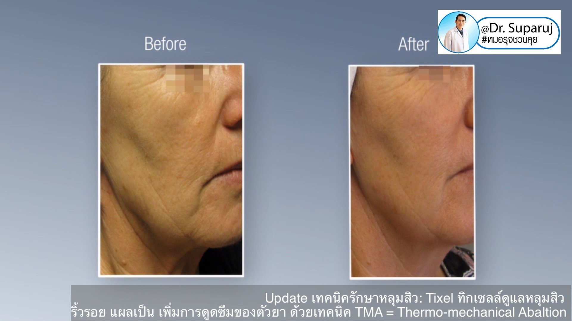 Update เทคนิครักษาหลุมสิว: Tixel ทิ๊กเซลล์ รักษาหลุมสิว ริ้วรอย แผลเป็น เพิ่มการดูดซึมยาด้วยเทคนิค TMA = Thermo-mechanical Abaltion Update เทคนิครักษาหลุมสิว: Tixel ทิ๊กเซลล์ รักษาหลุมสิว ริ้วรอย แผลเป็น เพิ่มการดูดซึมยาด้วยเทคนิค TMA = Thermo-mechanical Abaltion