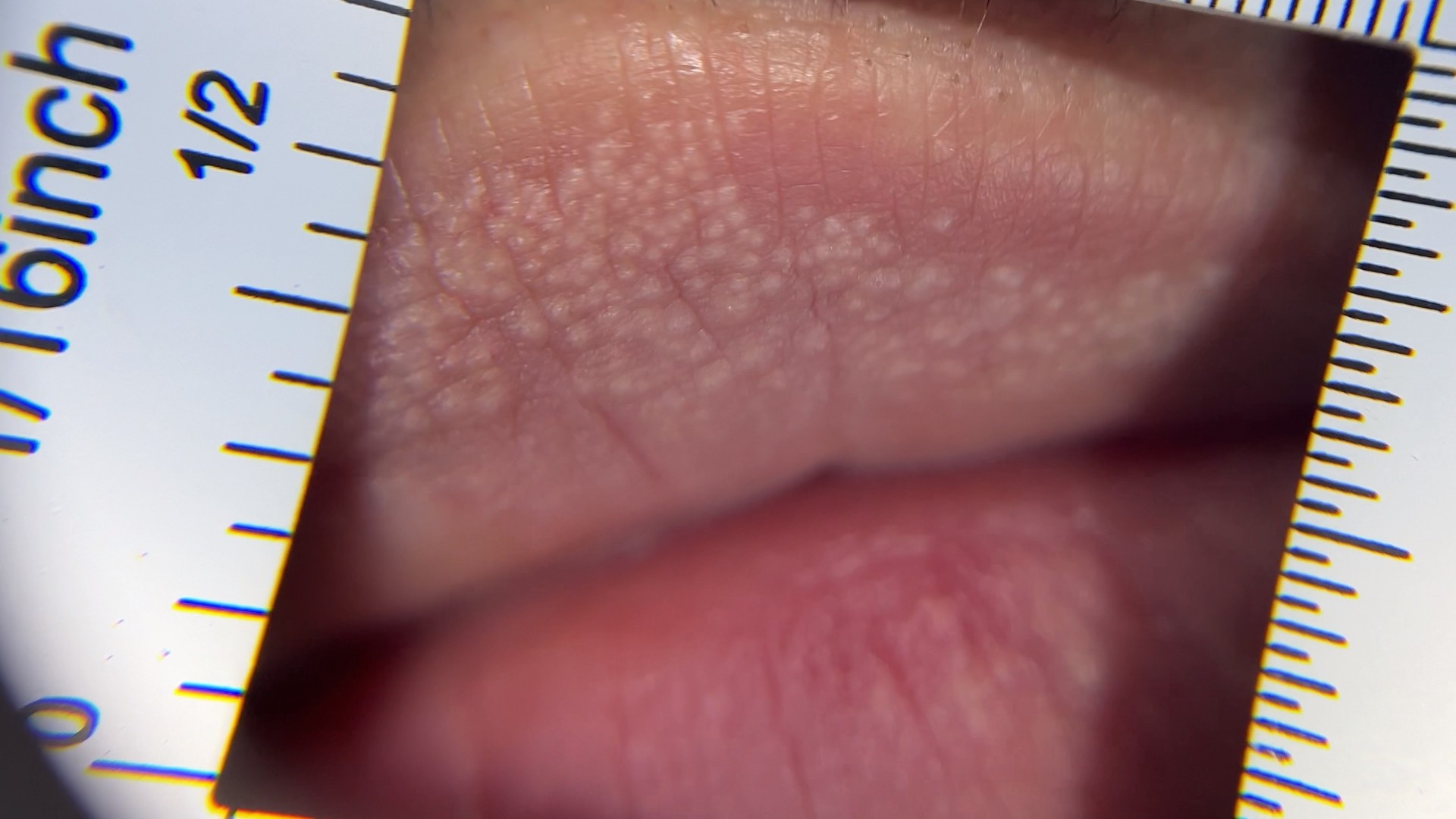 Fordyce Spot ตุ่มไขมันที่ริมฝีปาก คืออะไร มีลักษณะอย่างไร & มีวิธีดูแลได้อย่างไรบ้าง? Fordyce Spot ตุ่มไขมันที่ริมฝีปาก คืออะไร มีลักษณะอย่างไร & มีวิธีดูแลได้อย่างไรบ้าง?