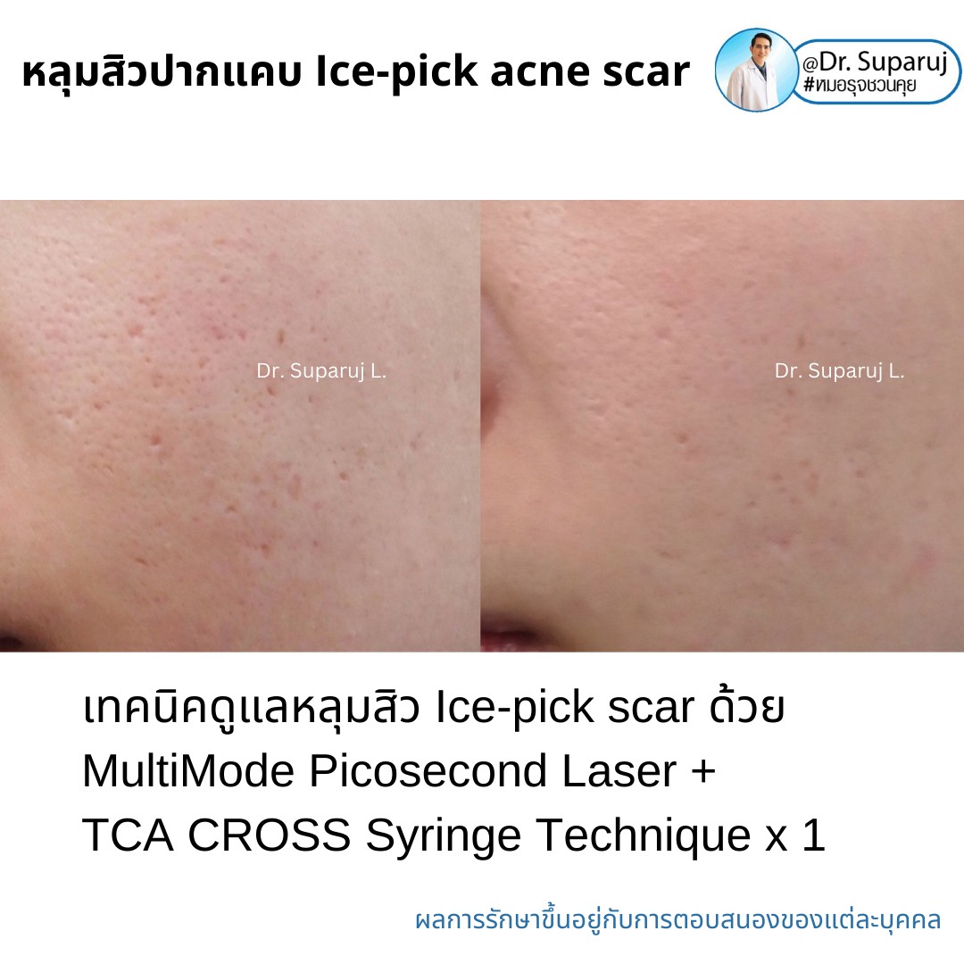 แนะนำเทคนิครักษาหลุมสิวจิกลึก Ice Pick Acne Scar ด้วยเทคนิคเลเซอร์ UltraDeep Pico Technique (Ice Pick Acne Scar Treatment with Discovery Pico Laser + UltraDeep Pico Technique) แนะนำเทคนิครักษาหลุมสิวจิกลึก Ice Pick Acne Scar ด้วยเทคนิคเลเซอร์ UltraDeep Pico Technique (Ice Pick Acne Scar Treatment with Discovery Pico Laser + UltraDeep Pico Technique)