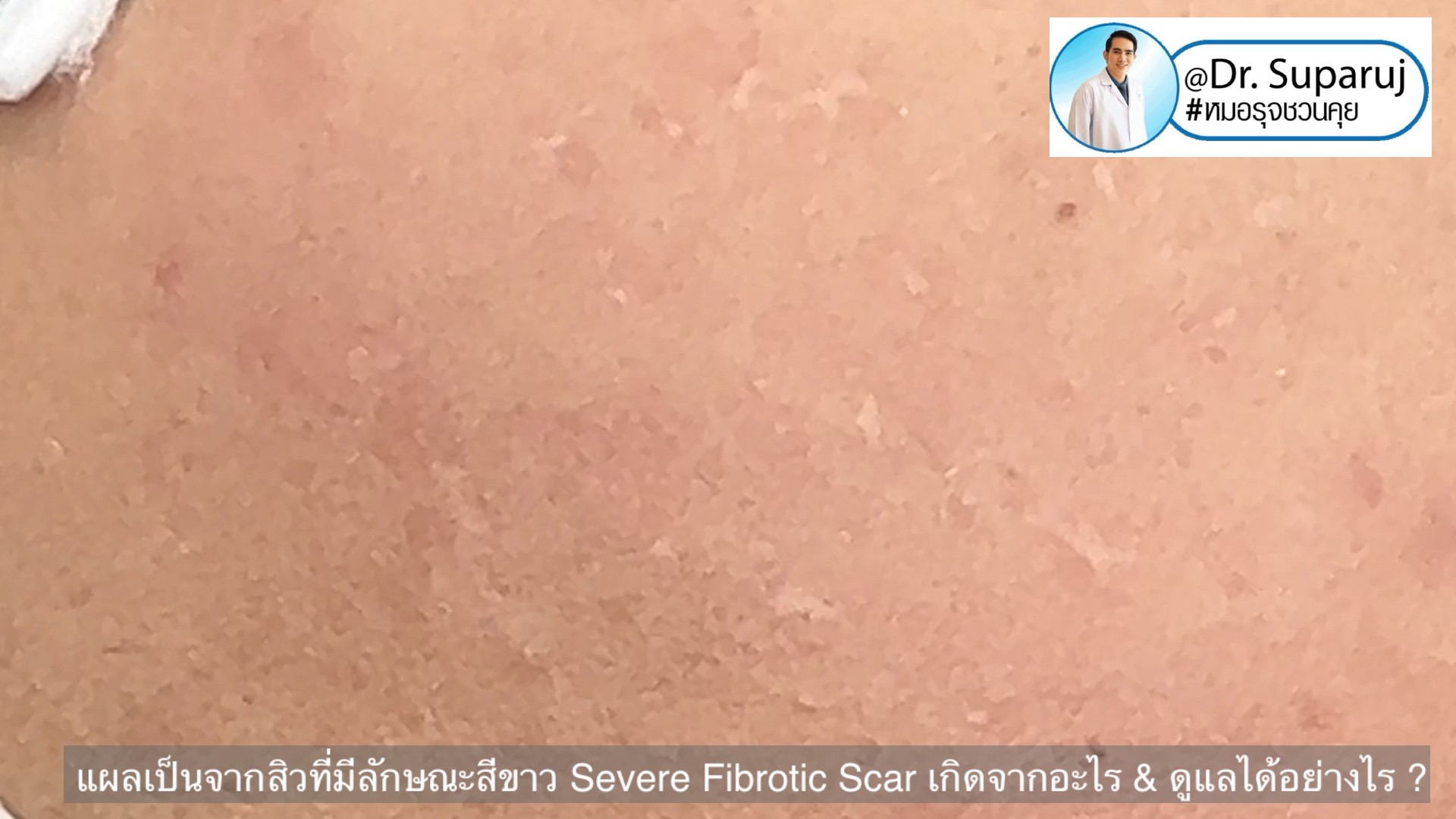 แผลเป็นจากสิวที่มีลักษณะสีขาว severe fibrotic acne scar เกิดจากอะไร & ดูแลได้อย่างไร ?