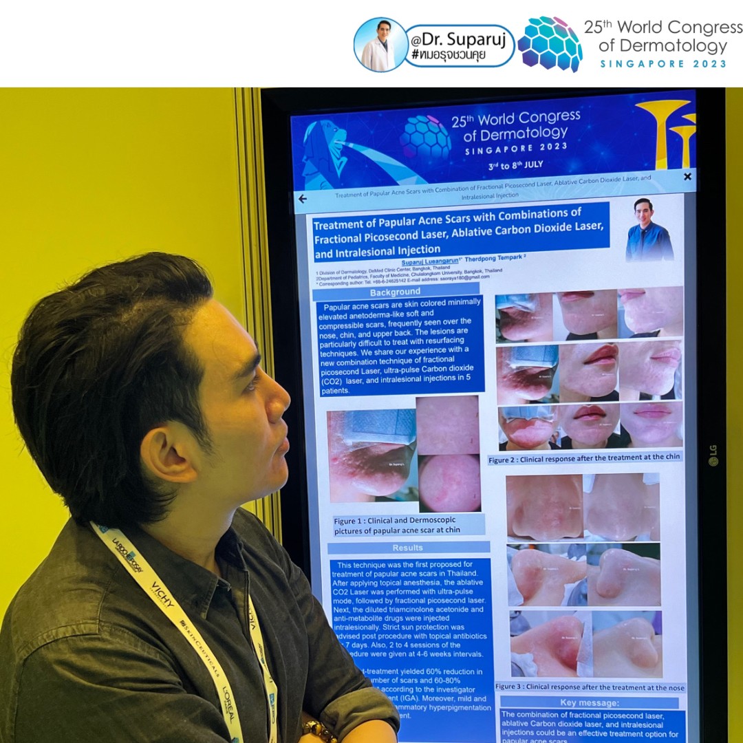 หมอรุจได้เข้าร่วมประชุม และนำเสนอผลงานวิจัยด้านการรักษาหลุมสิวแผลเป็นผมร่วงผมบาง ในงานประชุมแพทย์ผิวหนังระดับโลก World Congress of Dermatology WCD2023 ที่ประเทศสิงคโปร์ครับ หมอรุจได้เข้าร่วมประชุม และนำเสนอผลงานวิจัยด้านการรักษาหลุมสิวแผลเป็นผมร่วงผมบาง ในงานประชุมแพทย์ผิวหนังระดับโลก World Congress of Dermatology WCD2023 ที่ประเทศสิงคโปร์ครับ