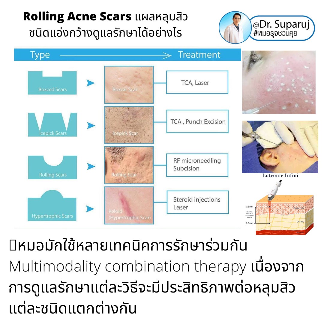 เป็นหลุมสิว แต่ยังไม่พร้อมรักษาหลุมสิว ทำอย่างไรดี? (+ เทคนิคการ เลือกใช้วิธีรักษาลุมสิวเบื้องต้นครับ) เป็นหลุมสิว แต่ยังไม่พร้อมรักษาหลุมสิว ทำอย่างไรดี? (+ เทคนิคการ เลือกใช้วิธีรักษาลุมสิวเบื้องต้นครับ)