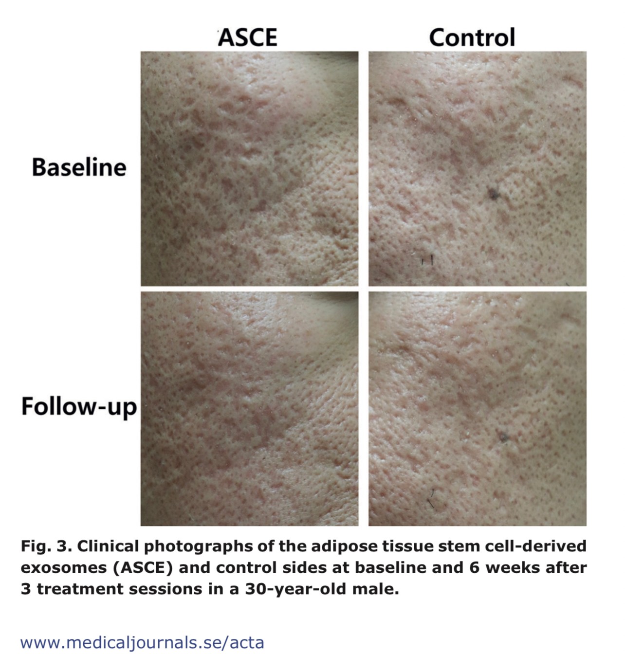 แนะนำเทคนิคในการดูแลหลุมสิว: Exosome ใน การรักษาหลุมสิว (Exosome & acne scar treatment)