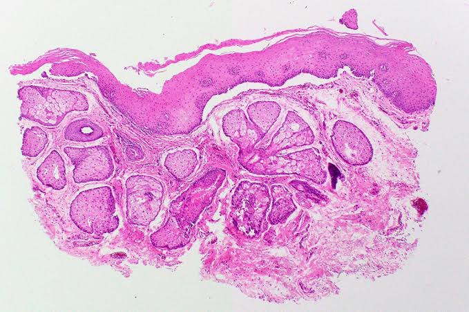 Fordyce Spot ตุ่มไขมันที่ริมฝีปาก คืออะไร มีลักษณะอย่างไร & มีวิธีดูแลได้อย่างไรบ้าง? Fordyce Spot ตุ่มไขมันที่ริมฝีปาก คืออะไร มีลักษณะอย่างไร & มีวิธีดูแลได้อย่างไรบ้าง?